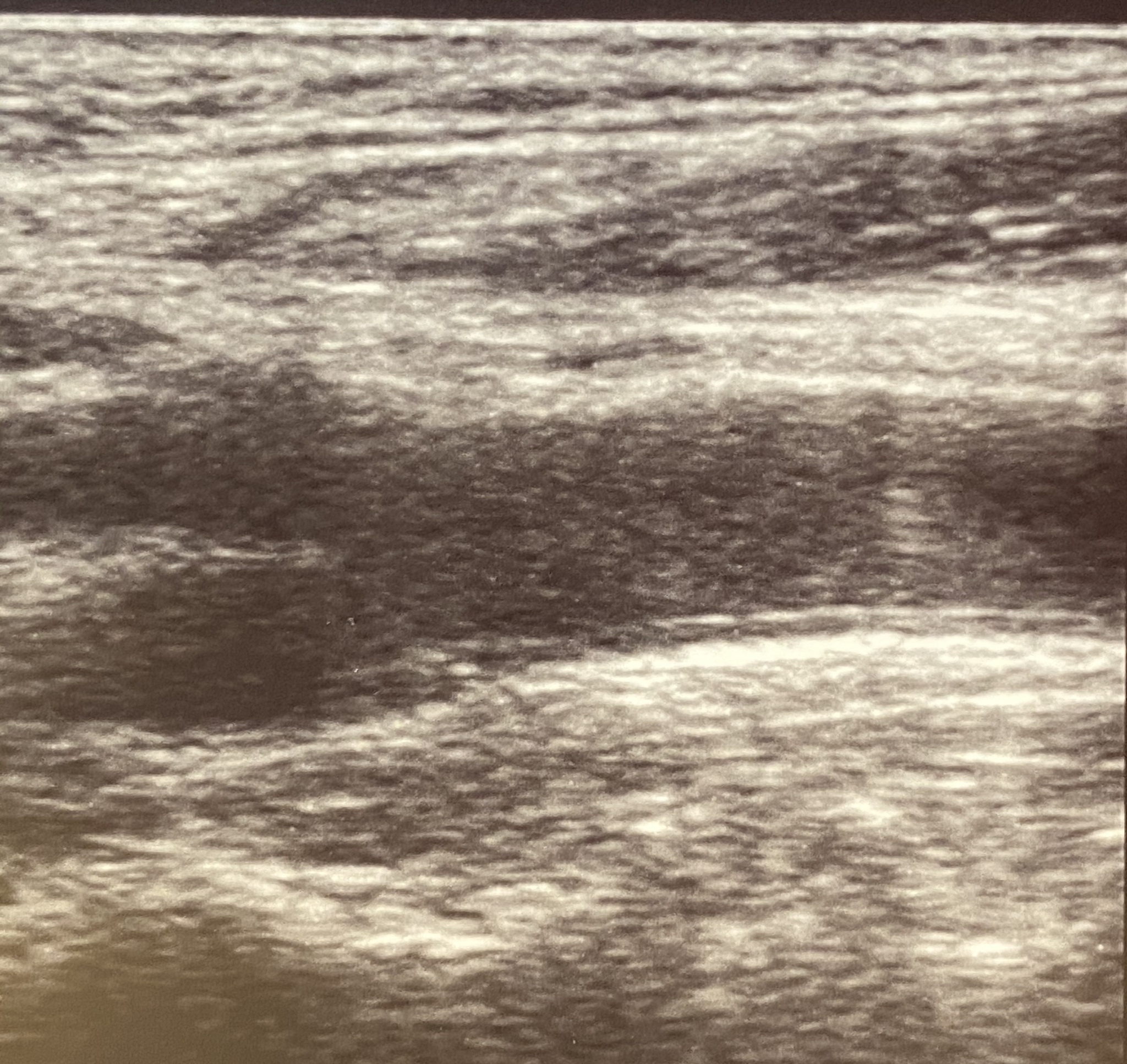 Right Internal Carotid Artery Plaque and Luminal Stenosis Detected During Admission Ultrasound