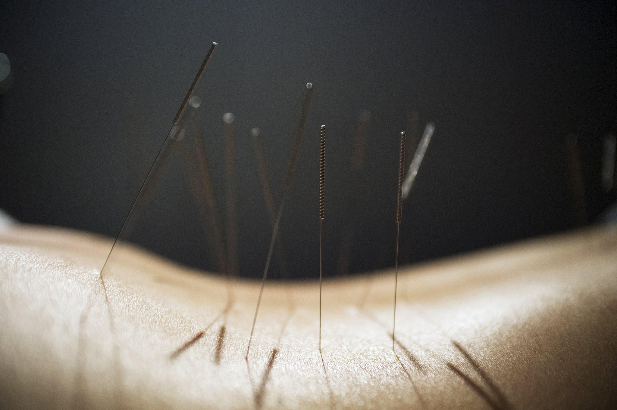 midsection of person with acupuncture needles on back against bl