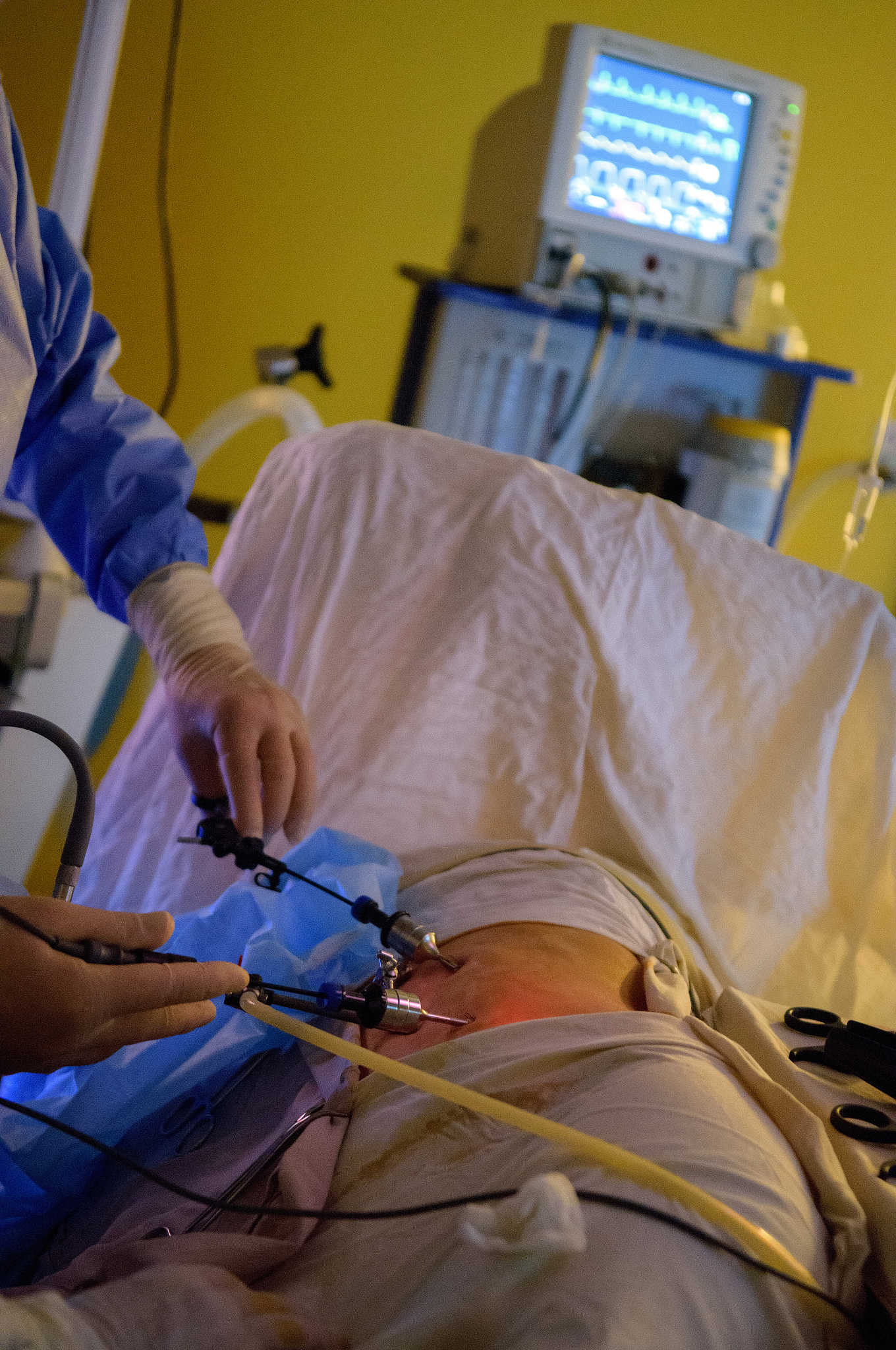 laparoscopic surgery operation