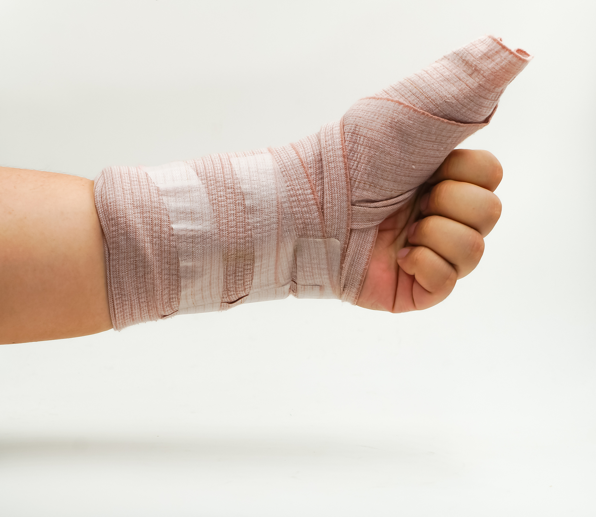 酮洛芬透入疗法治疗孕期拇指腱鞘炎：安全有效