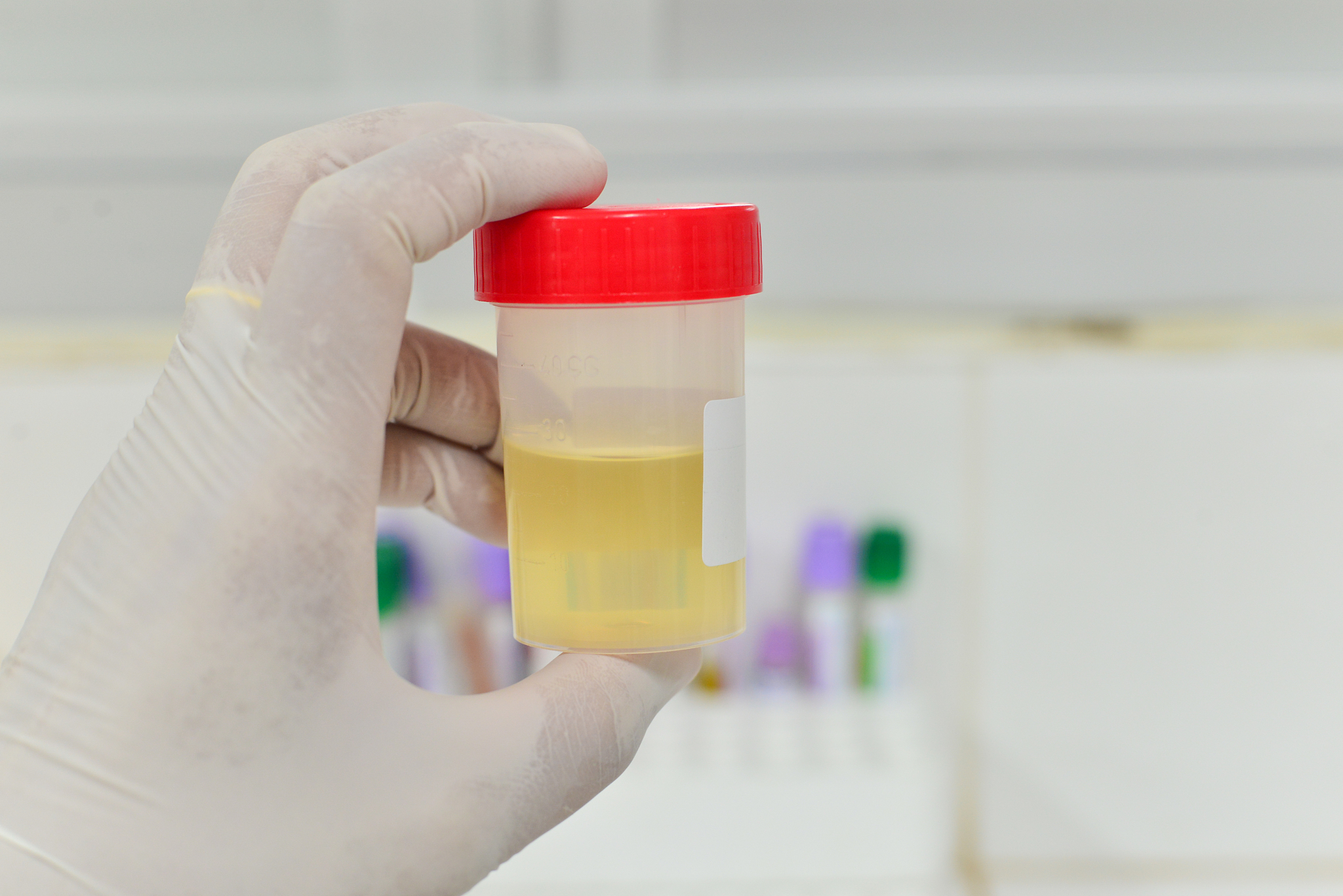 潜血、蛋白、尿比重、粘液丝偏高