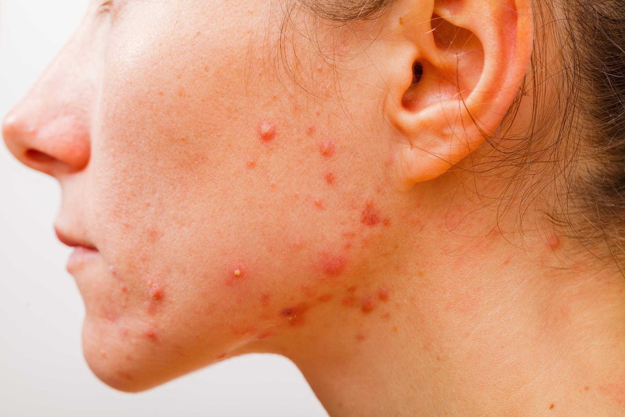 acne skin