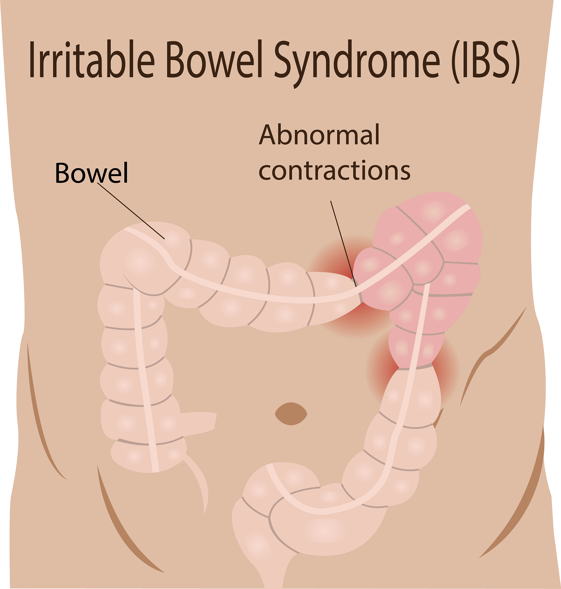 肠易激综合征(IBS)腹泻型：中医治疗有效缓解症状