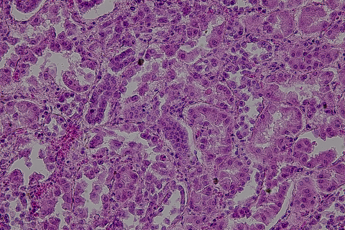 Early Stage Pancreatic Cancer: Symptoms, Diagnosis, Treatment & Management