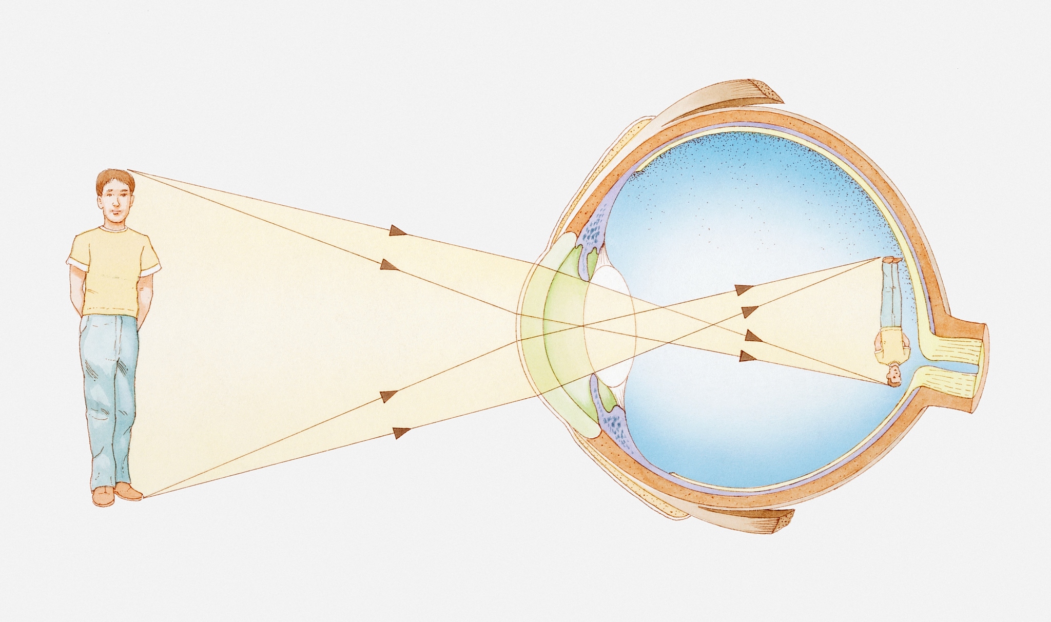近视眼和远视眼的光线传播路径及聚焦点位置