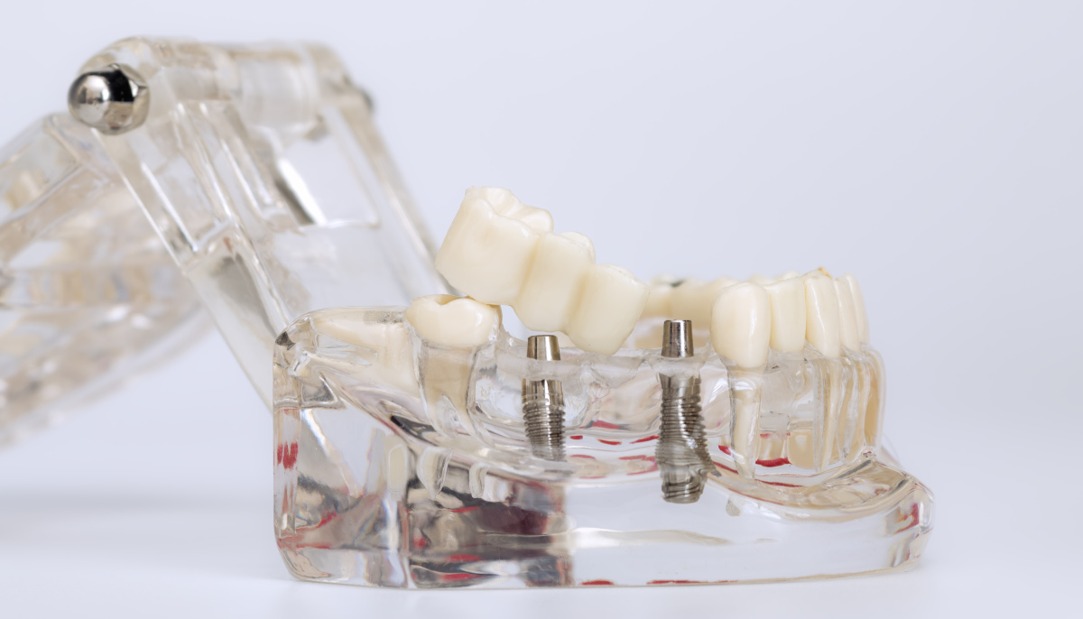 牙骨量不足还能做种植牙吗？