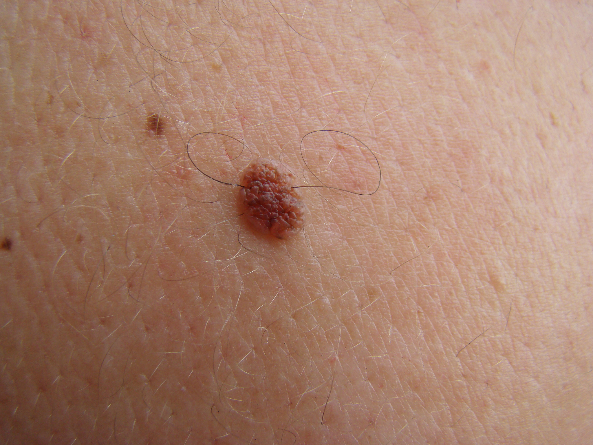 nevus
