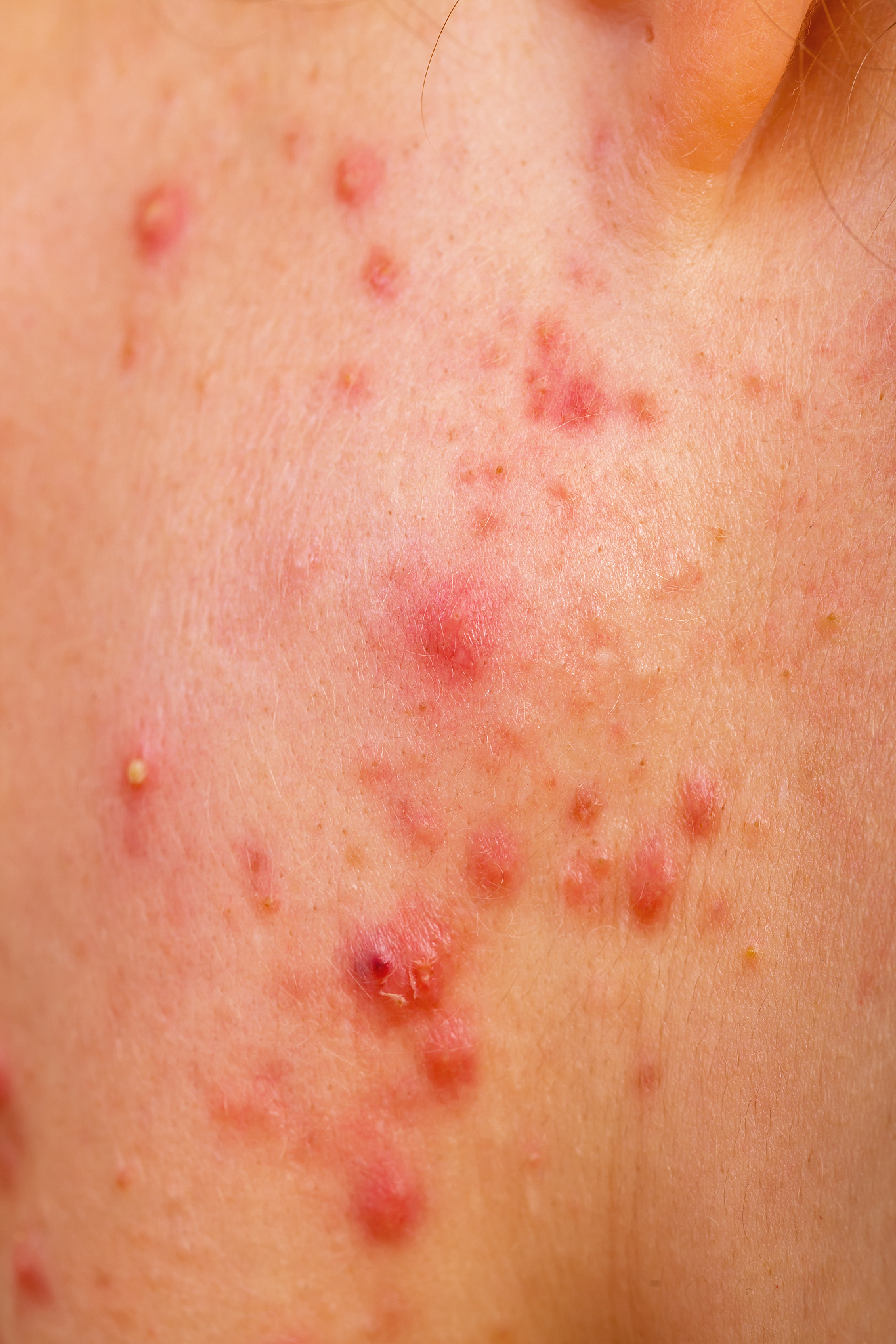 acne skin