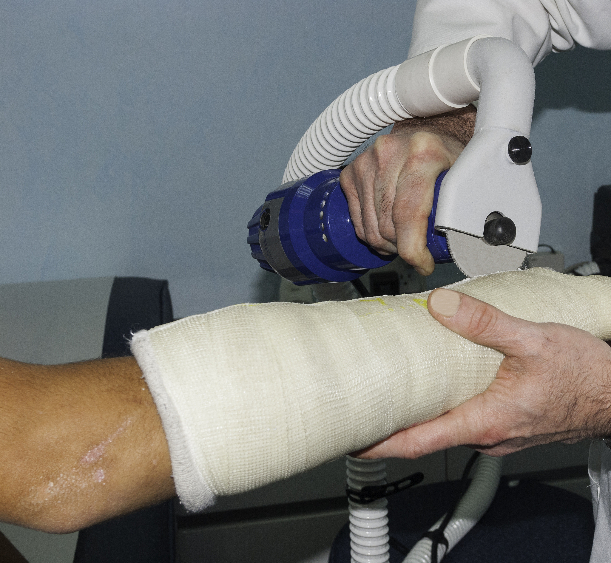 穴位注射联合电针治疗：骨质疏松伴病理性骨折的有效方法