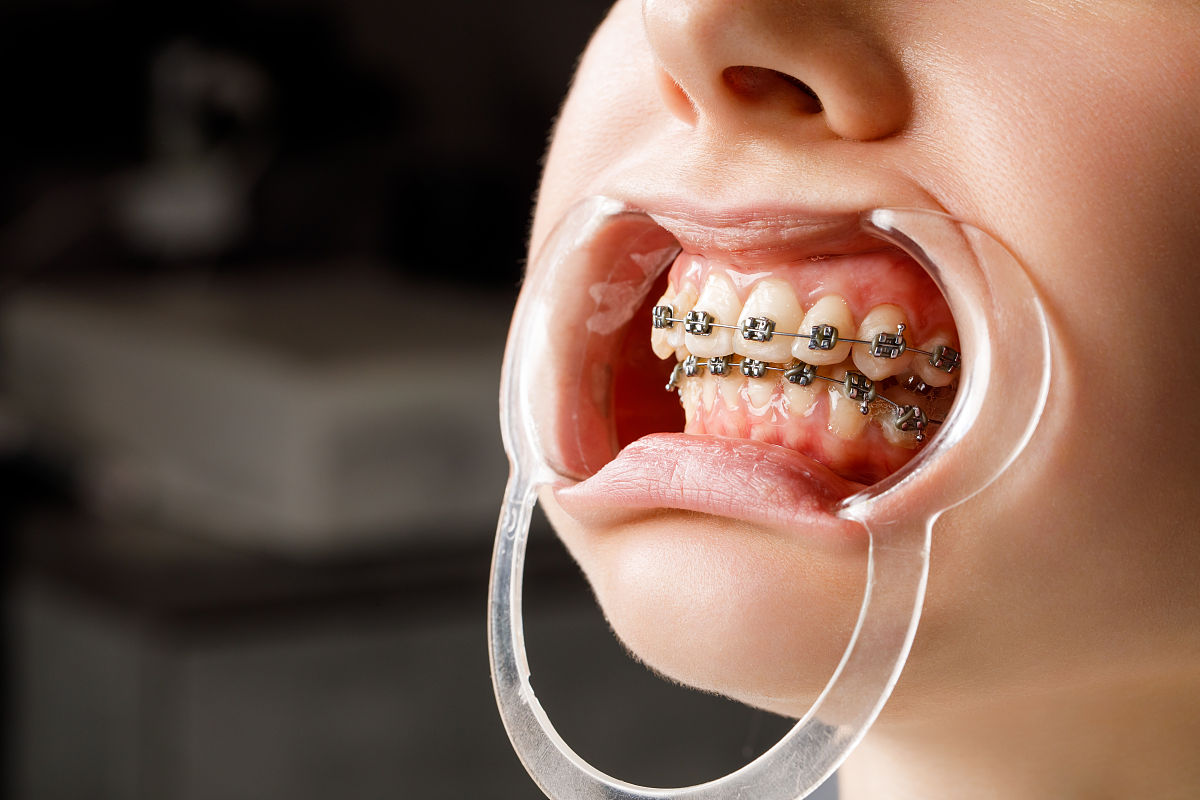 口呼吸导致骨性龅牙怎么办