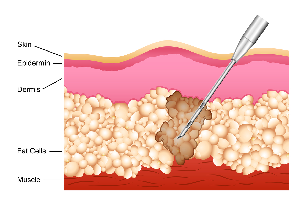 什么情况下会导致出现黑头？