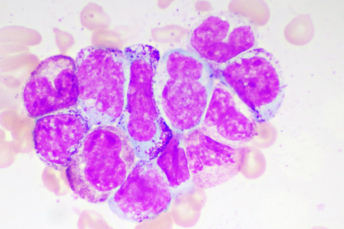 白血病能治愈吗？详解白血病治疗及治愈率