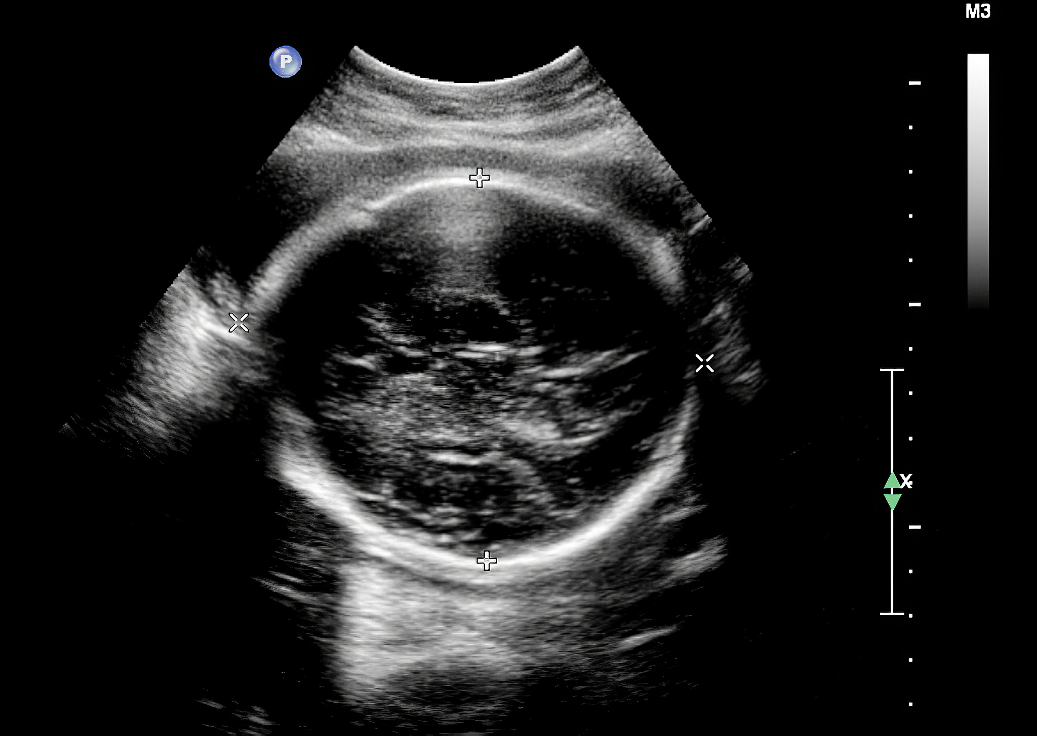 ultrasound of fetus in third month pregnancy