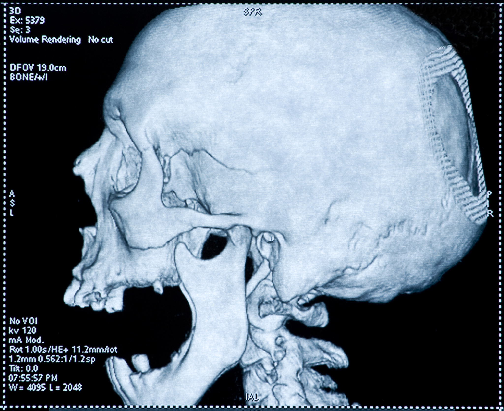 小脑扁桃体下疝伴相应颈髓受压变形做手术问题大吗