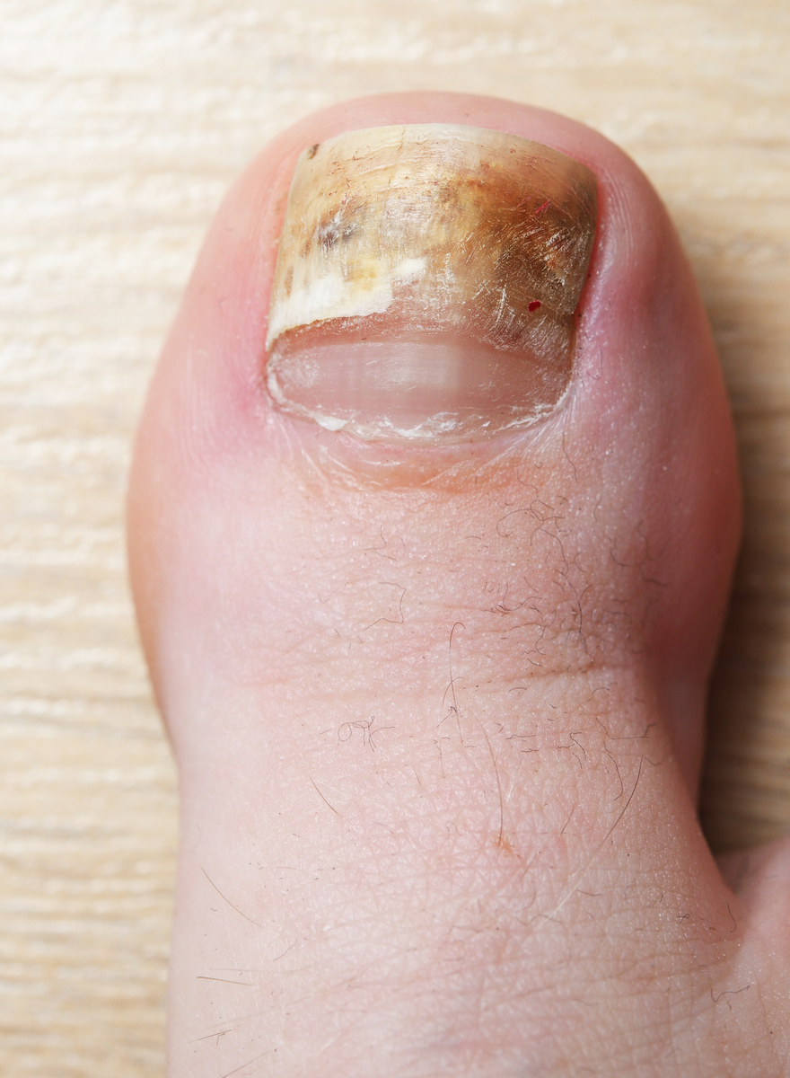 灰指甲原因：全面概述 - 了解灰指甲的常见原因