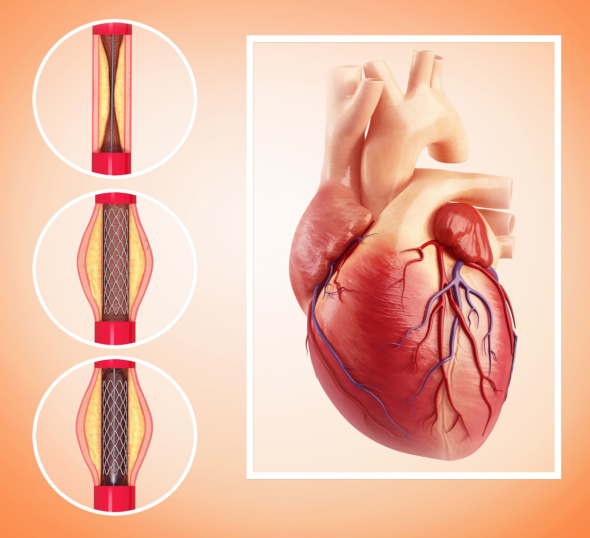 心脏支架的四个谣言，别再相信了！