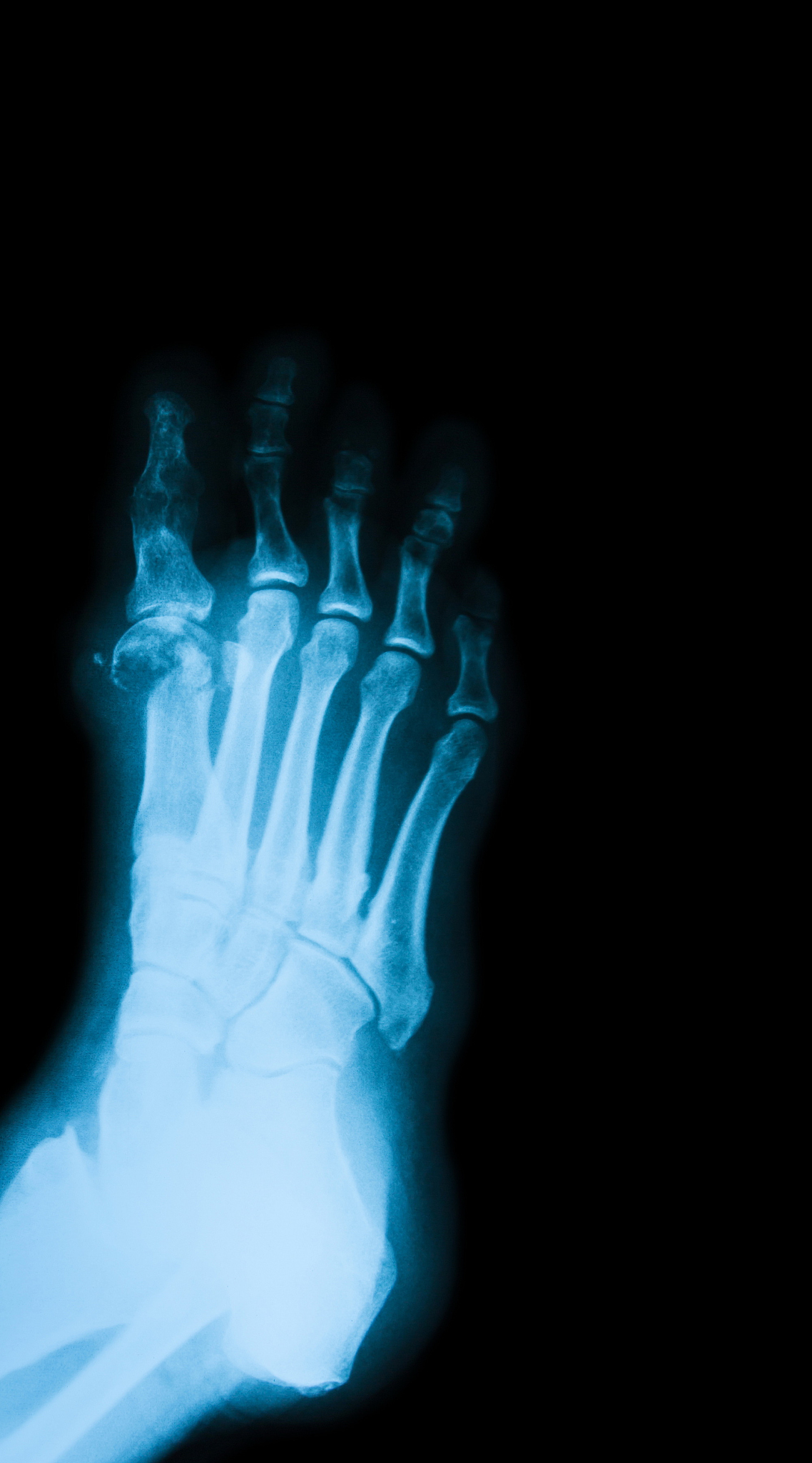 简述坏疽的类型常发生于哪些部位