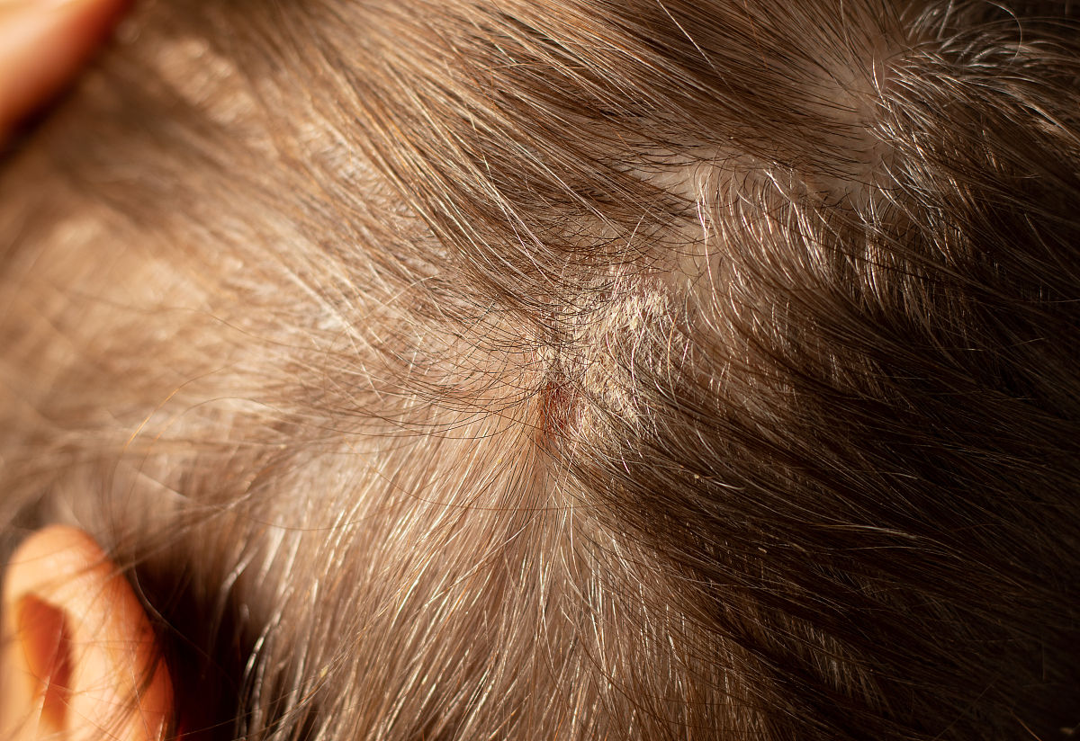 头皮痒怎么办？7个有效方法缓解头皮瘙痒