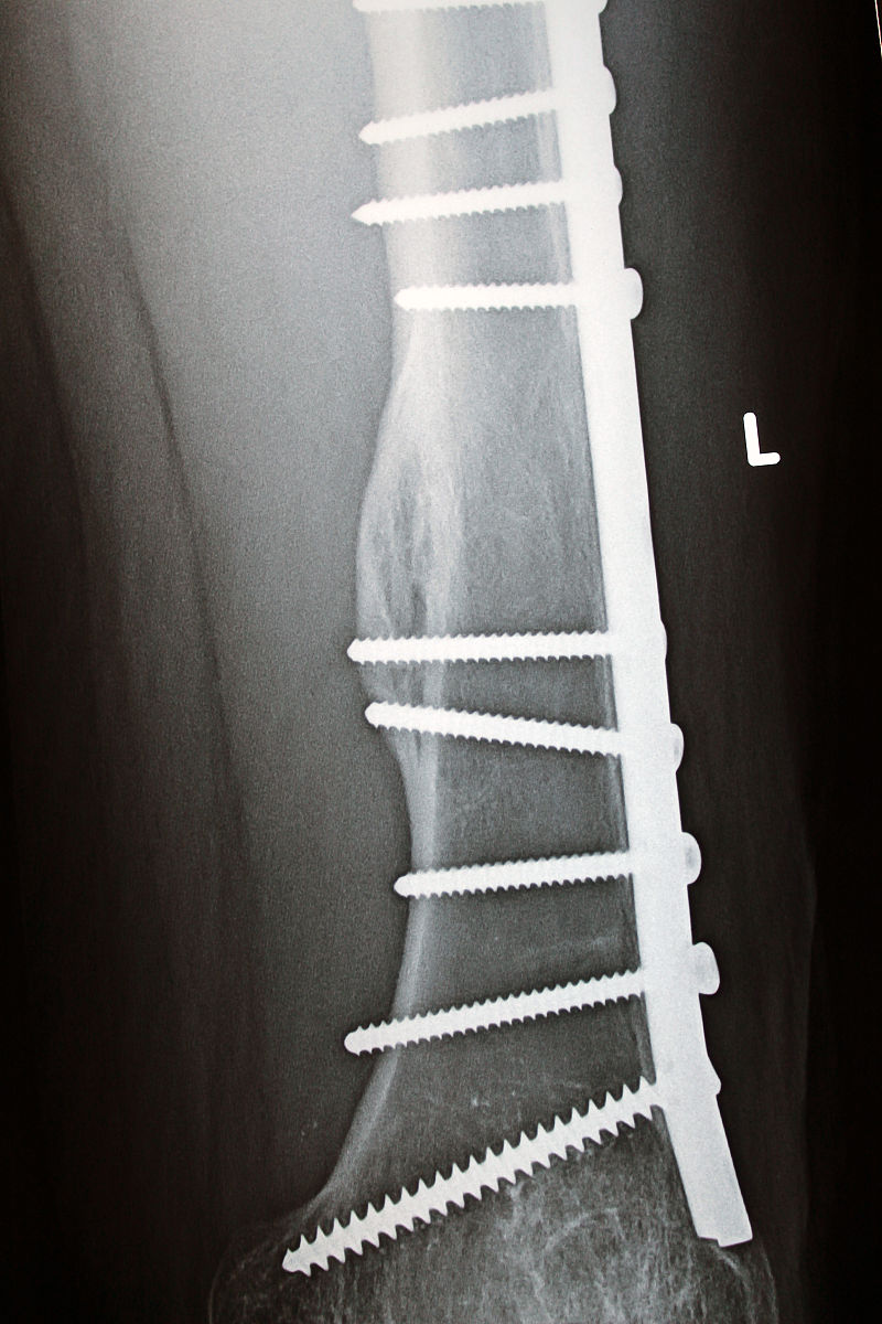 左股骨粗隆间骨折患者闭合复位PFNA内固定术治疗的重要性