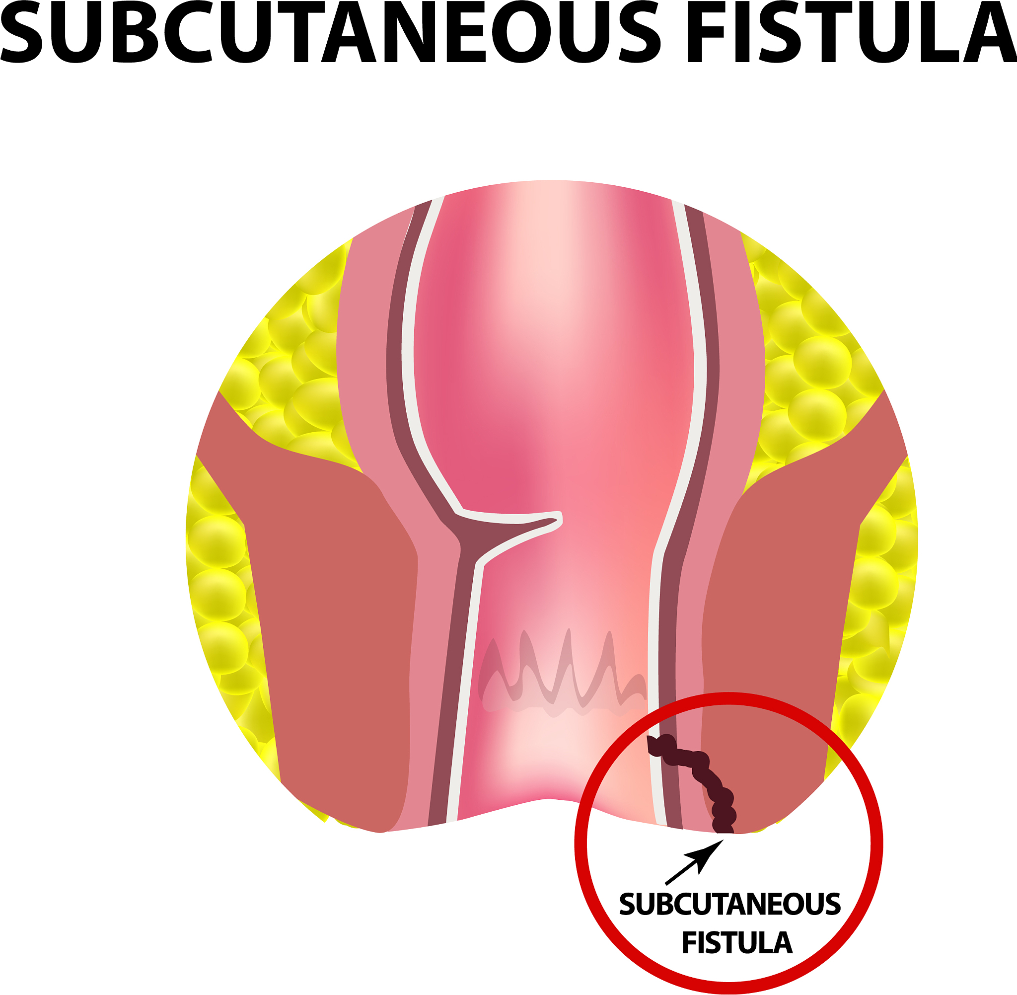 types of fistulas of the rectum paraproctitis