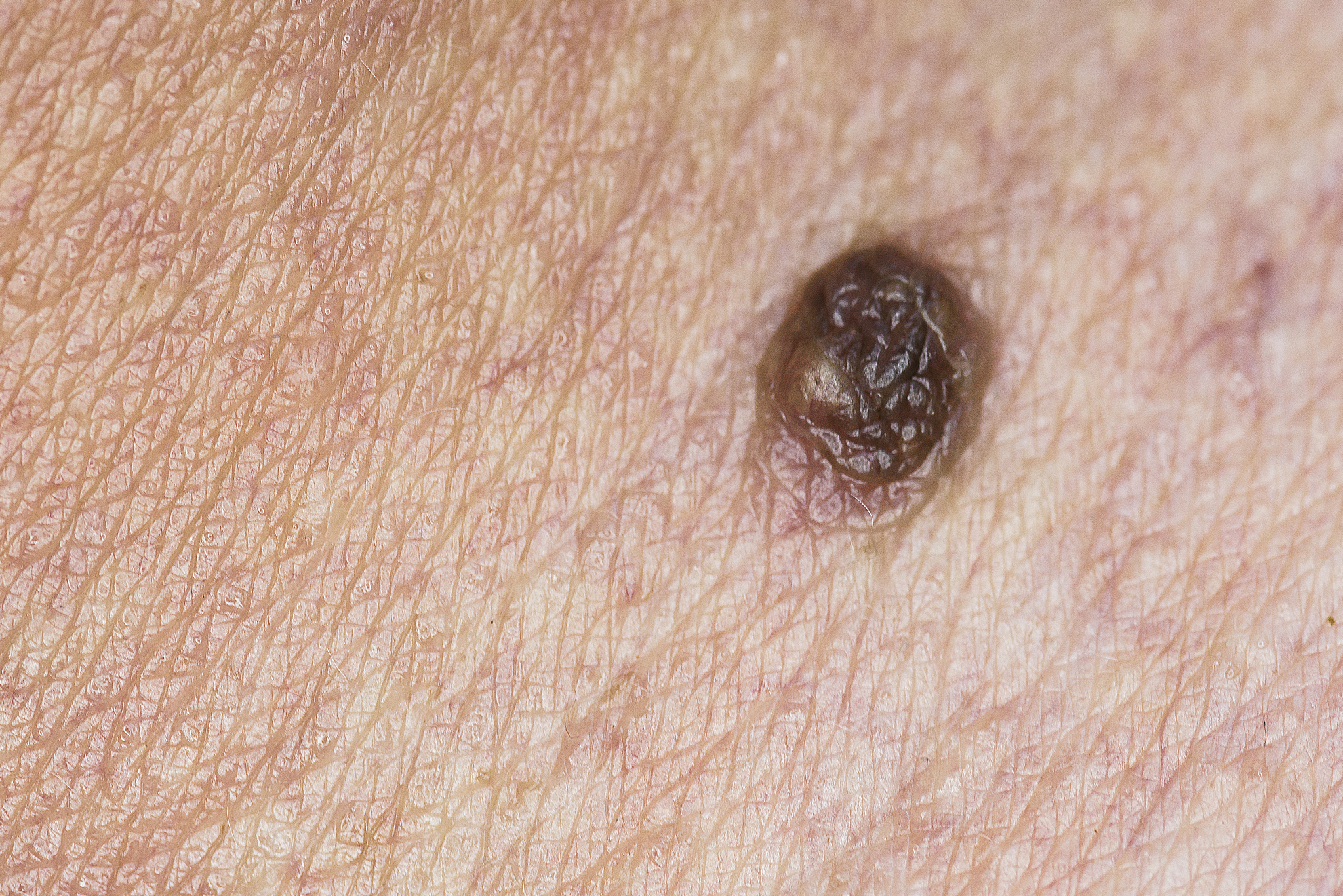 mole on human skin