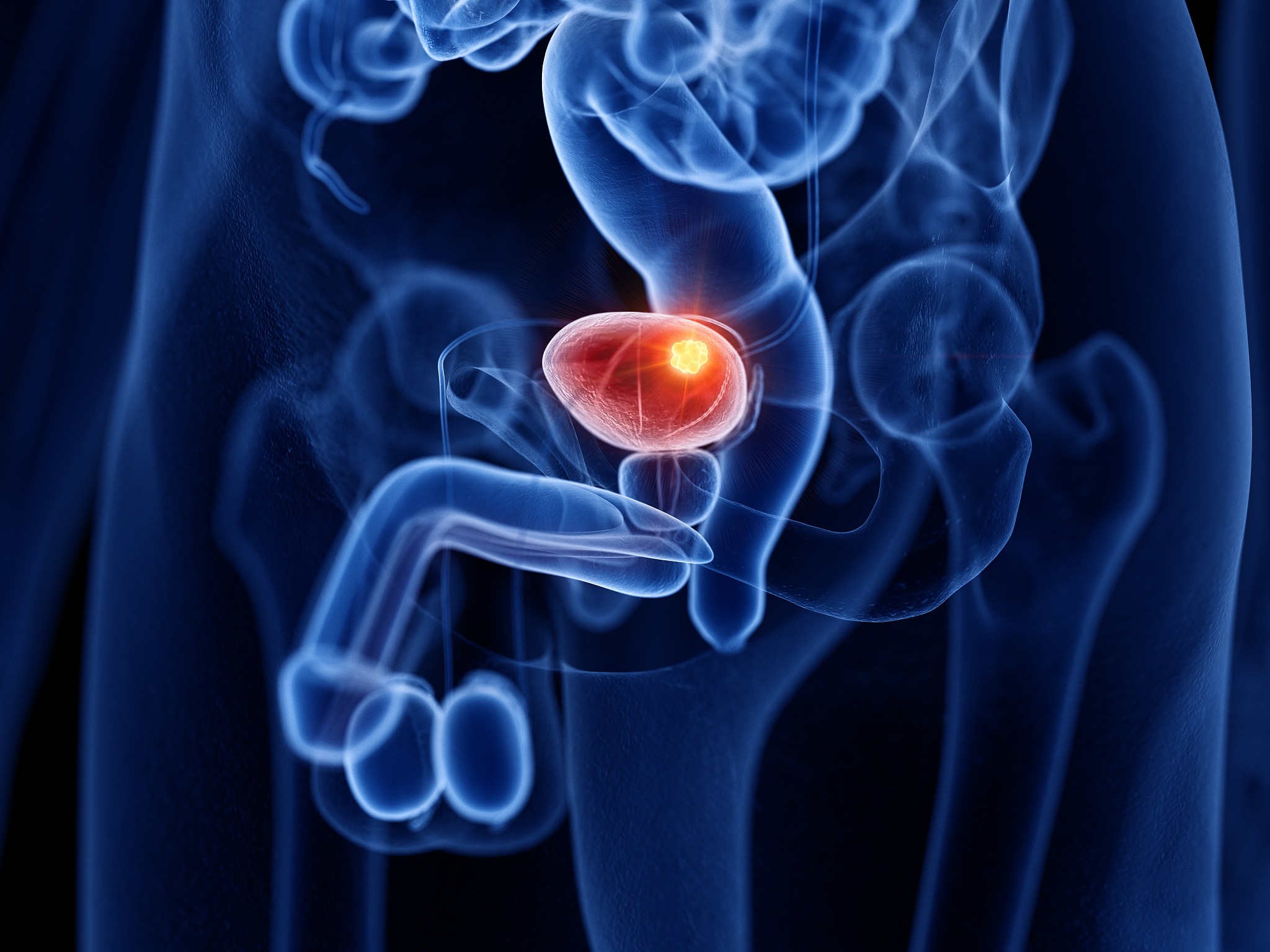 膀胱癌：症状、检查与病情观察指南