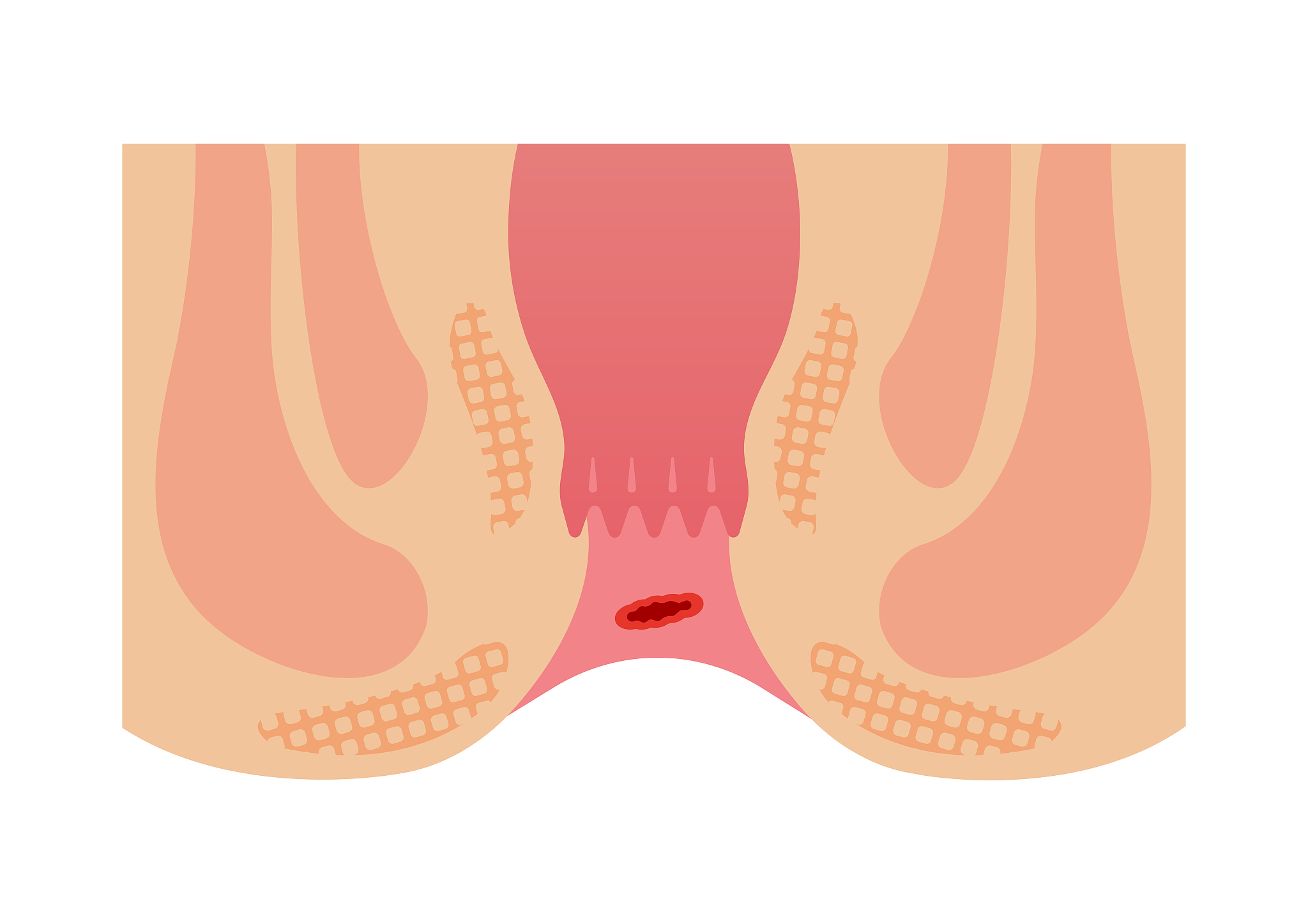 type of hemorrhoid flat vector illustration / bleeding hemorrhoi