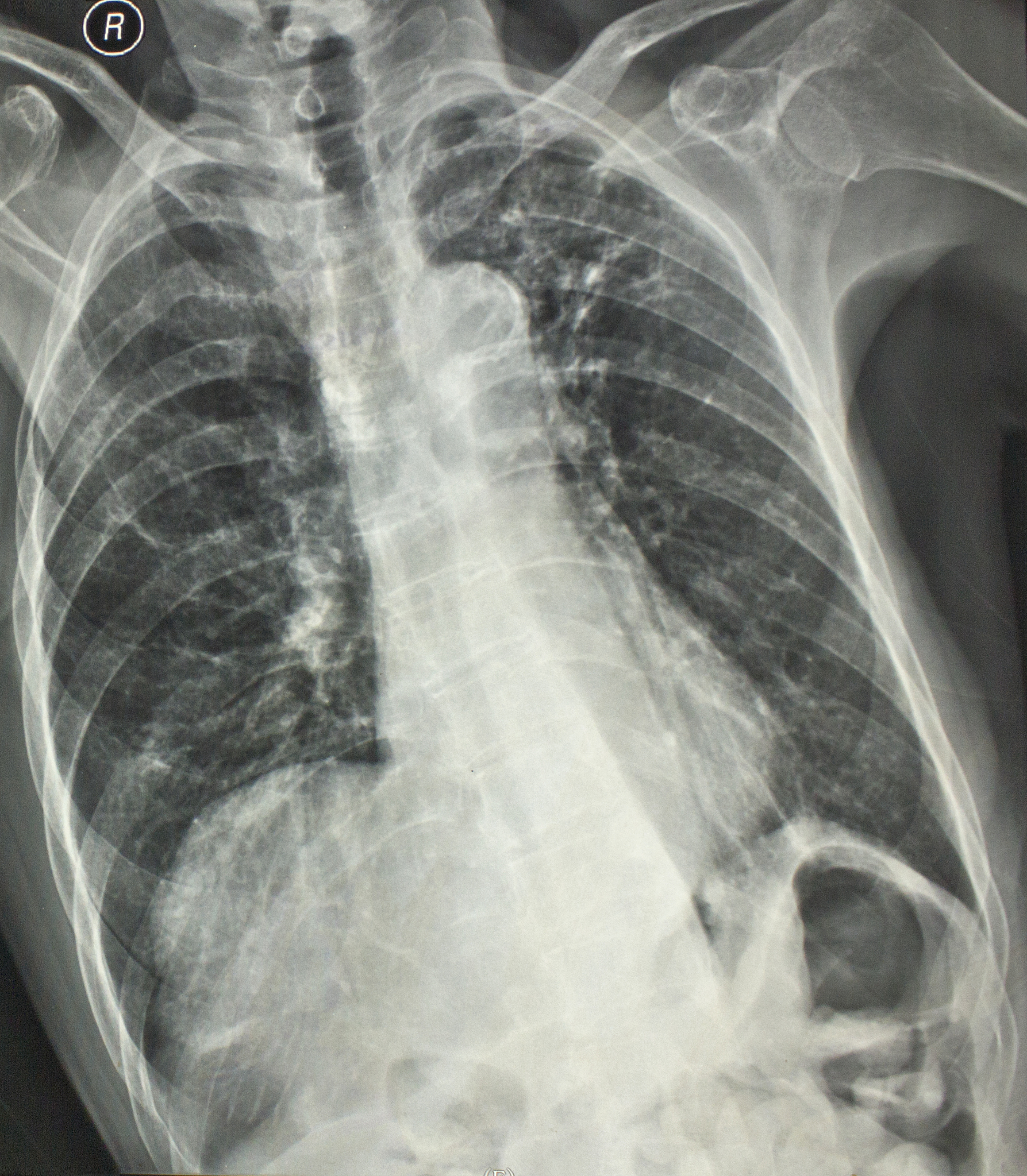 胸片发现小结节？医生为何建议做CT？