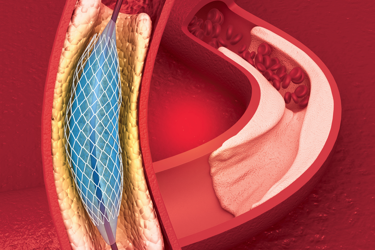 PCI 手术：治疗冠状动脉疾病的介入性治疗