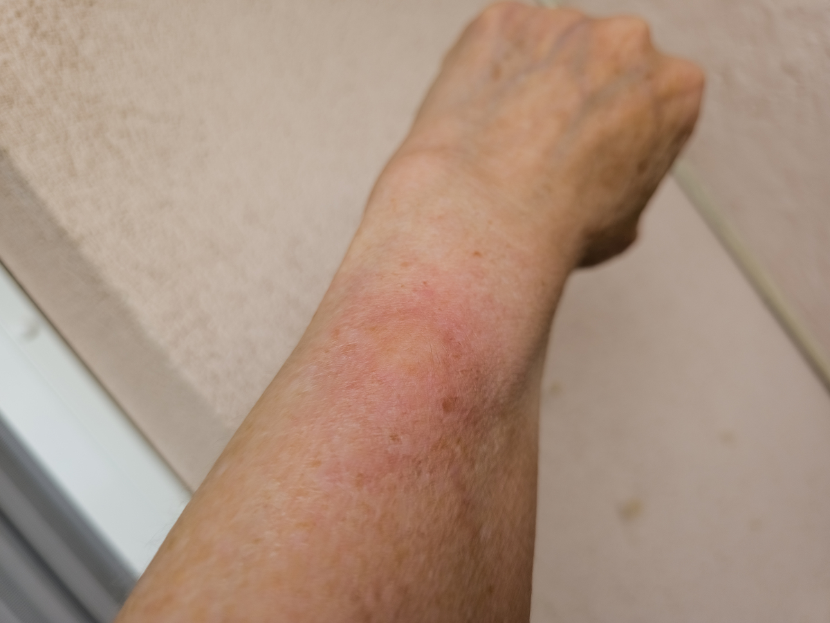 蚊子叮咬：原因、症状和缓解方法