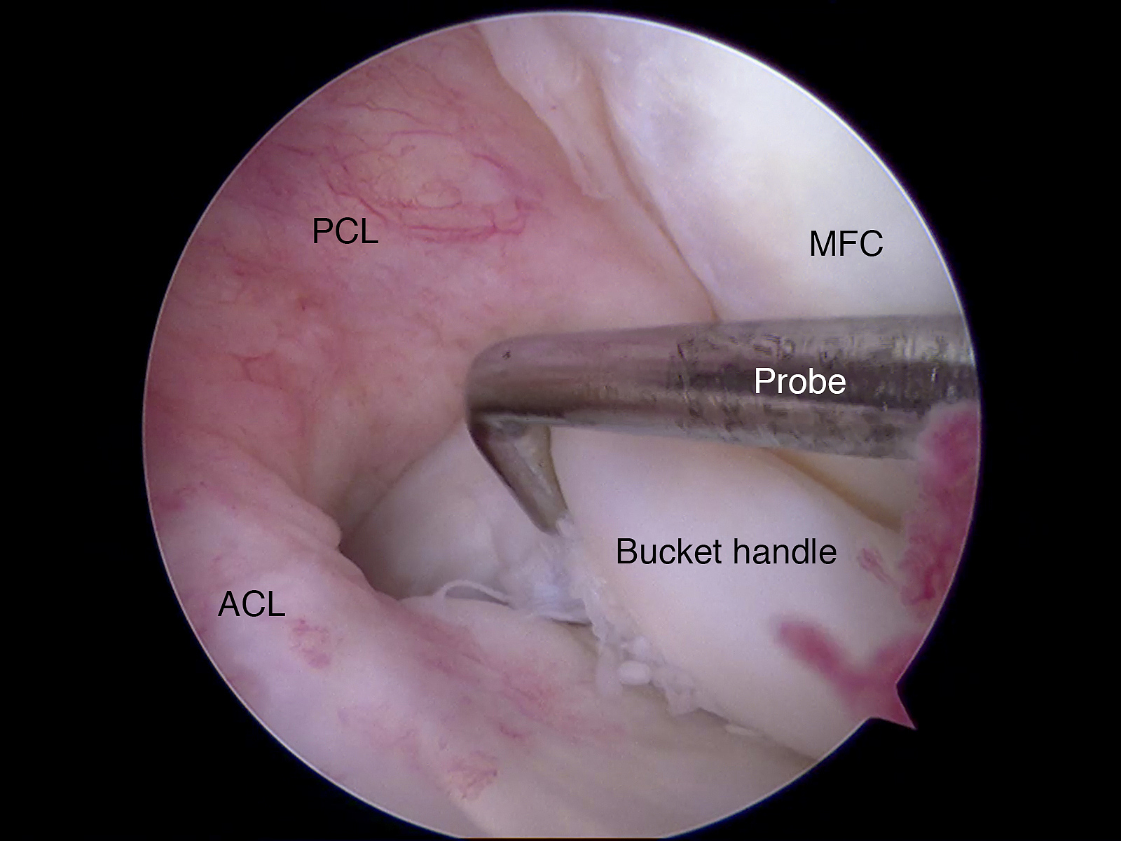踝关节镜LassoLoop手术：微创治疗踝关节损伤