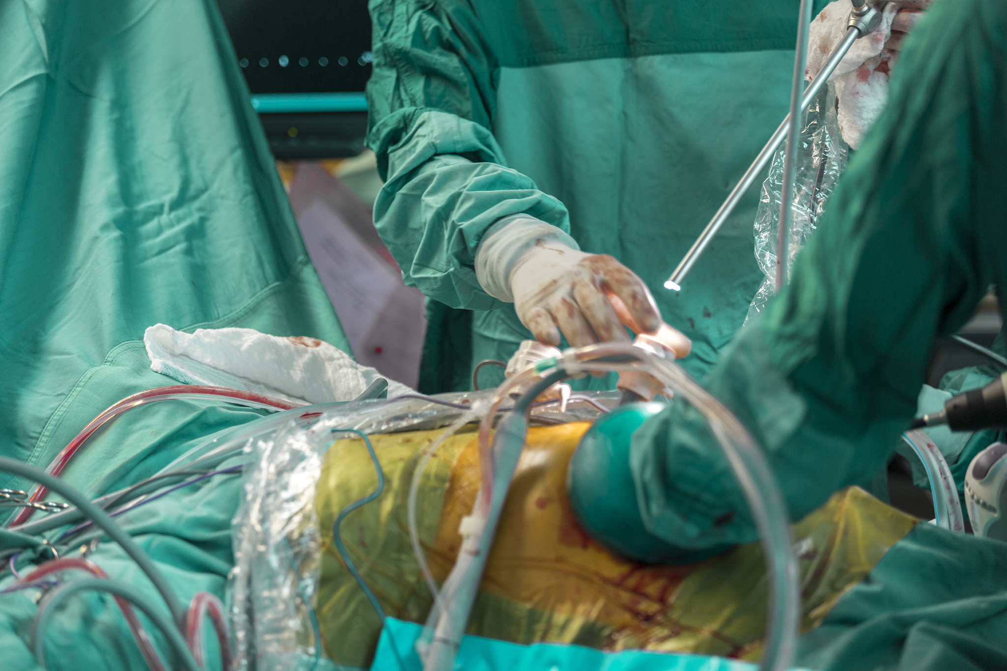 闭合性胸腹部损伤合并脾破裂：腹腔镜探查备剖腹手术护理要点