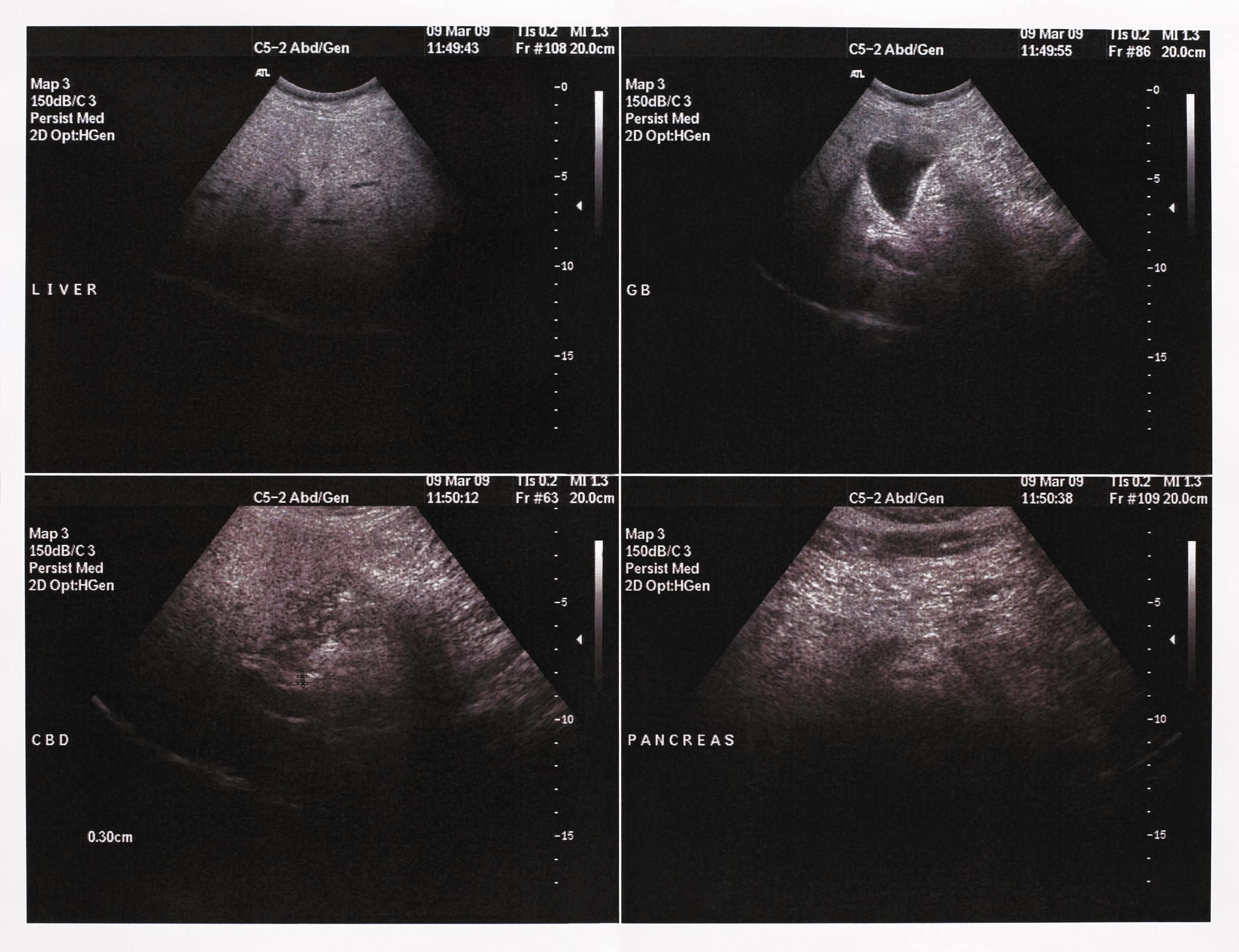 子宫内膜粘膜下肌瘤超声特征 - 诊断依据及鉴别诊断