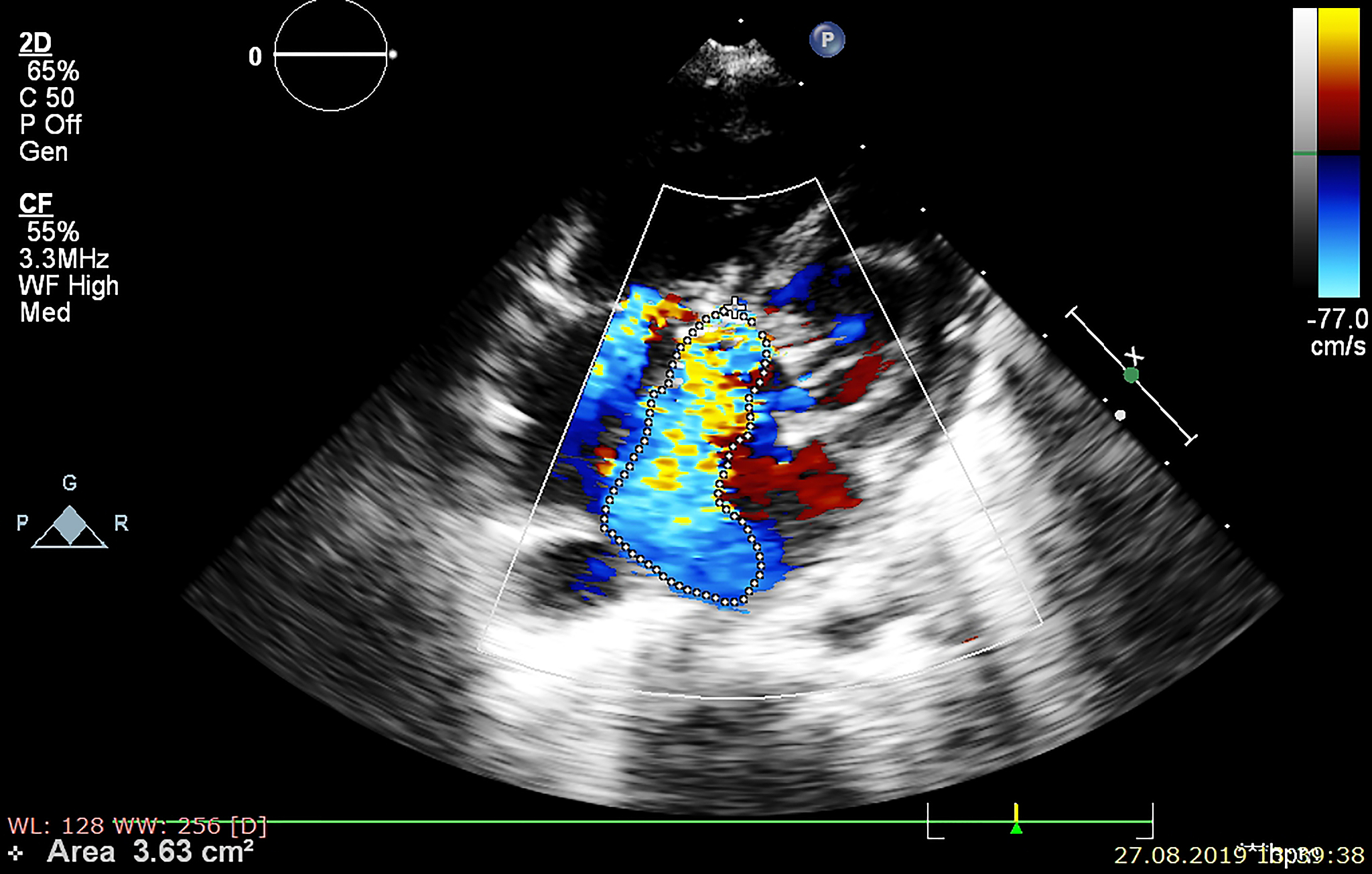 卵圆孔未闭 (PFO) 诊断：经胸超声心动图、经食道超声心动图和右心声学造影的对比研究
