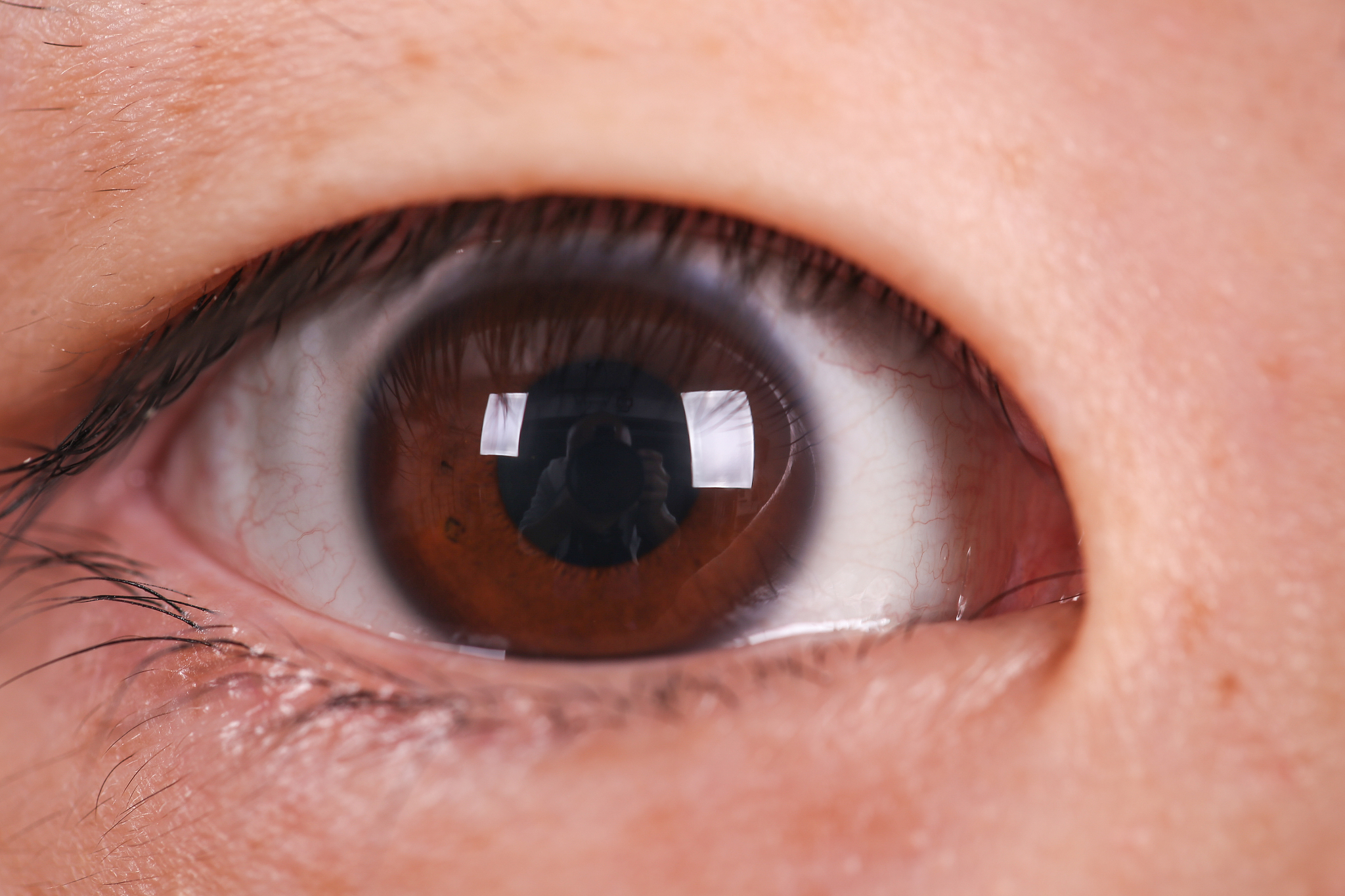 眼睛里飘着透明物体并有异物摩擦感？可能是这些眼部疾病