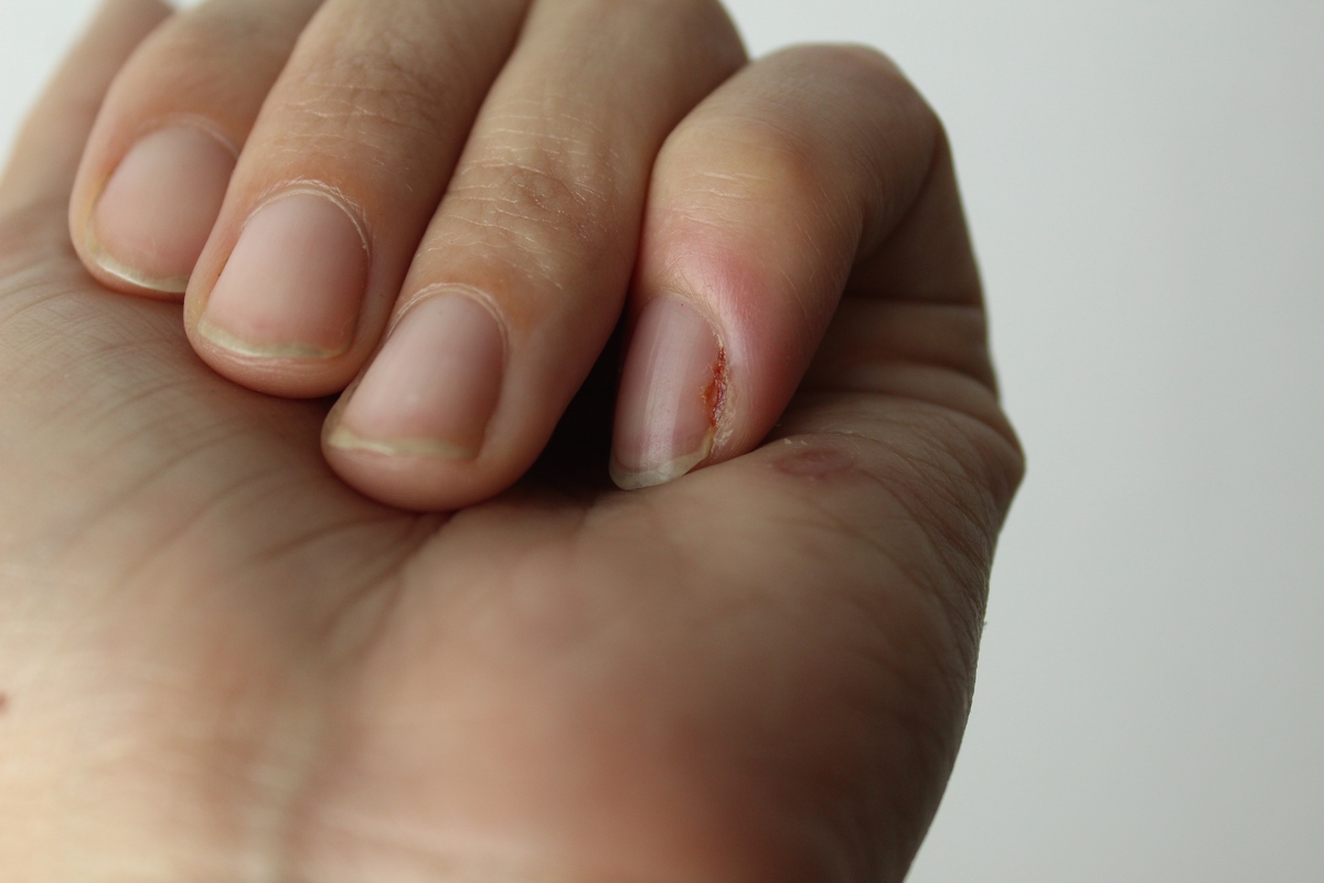 手指里面有个黑点 按压就疼是怎么回事