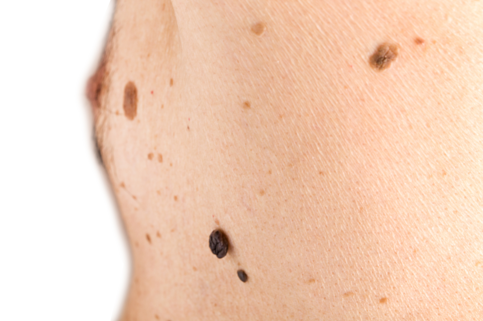 detail of the bare skin on man in the back, disorders of body wi