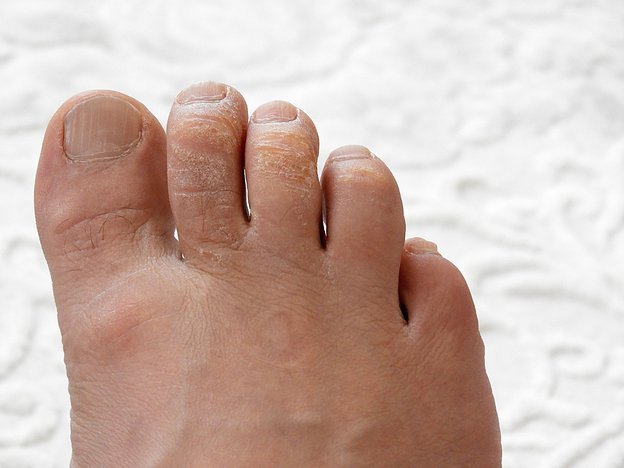 冻伤后组织水肿后下一阶段是什么症状