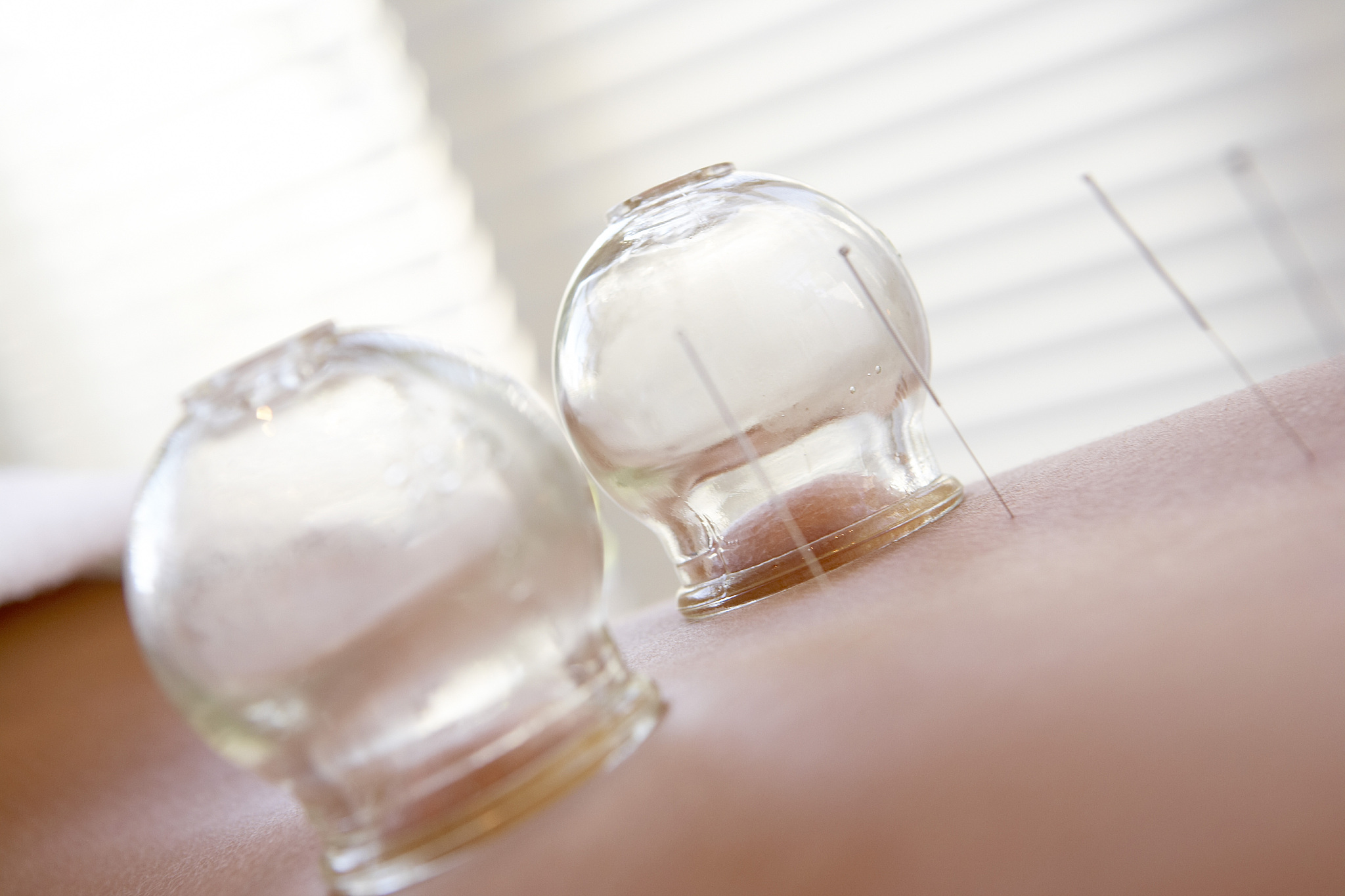 acupuncture needles and glass shapes on woman's back