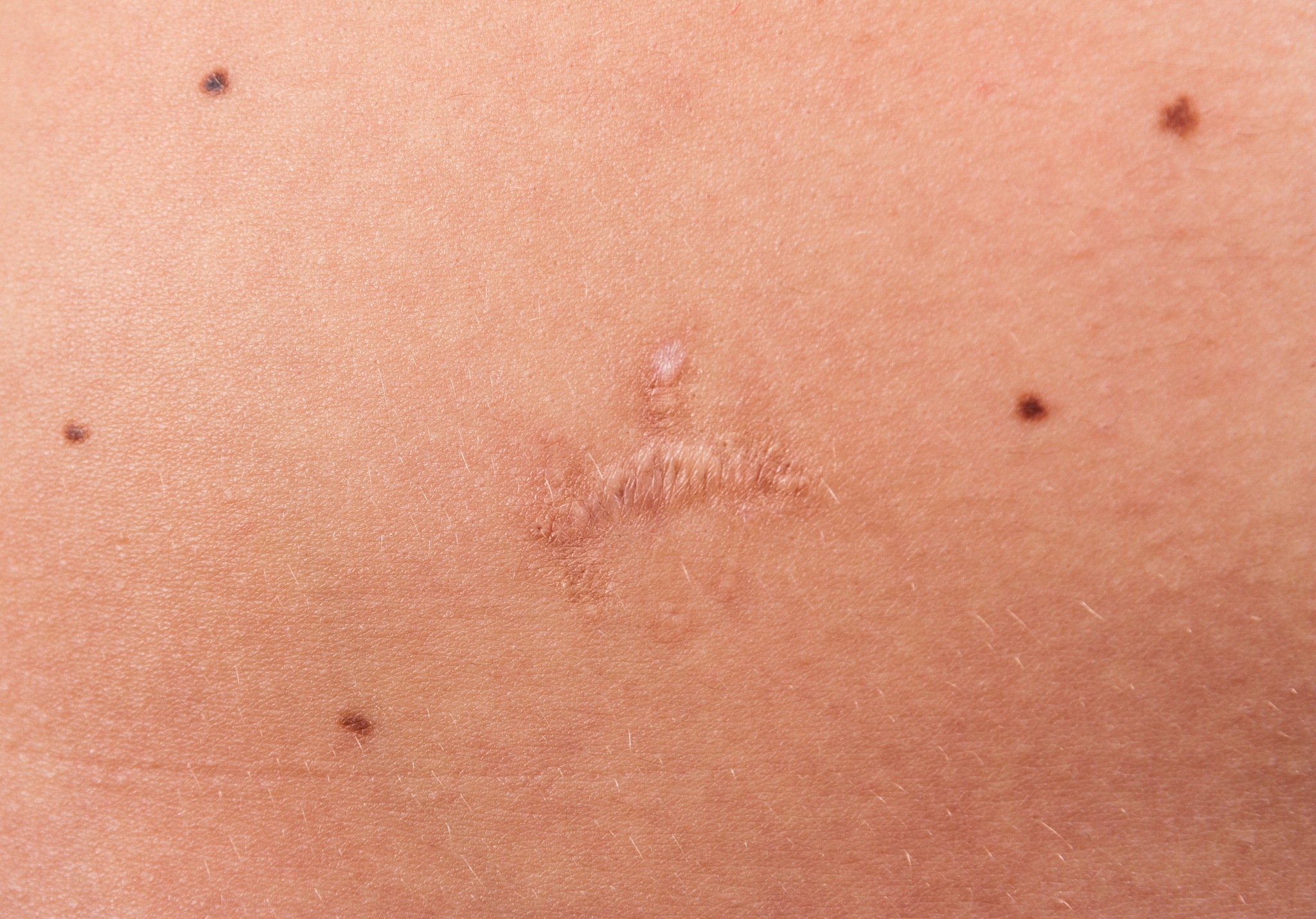 scar after the mole removal