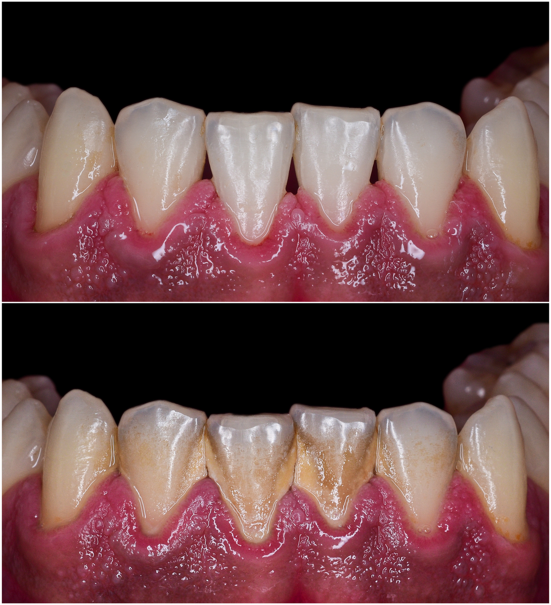 牙质受损怎么办？修复牙齿方法解析