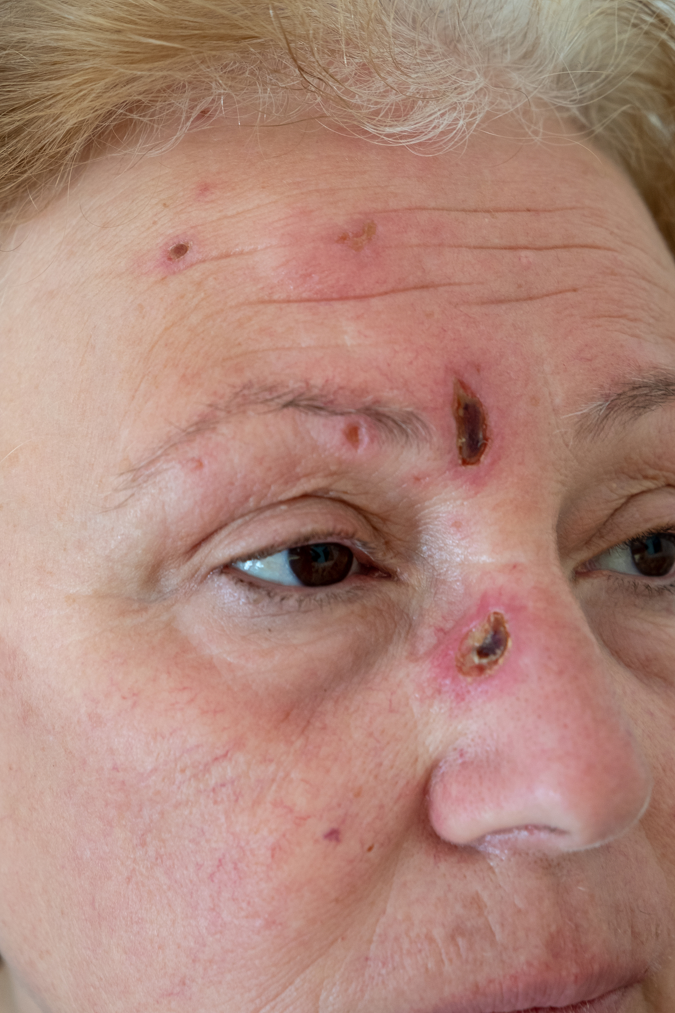 脸里硬块挤出来是血有淤青