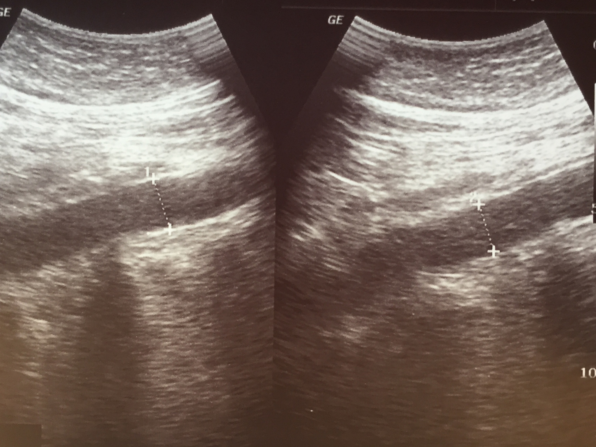 血管内超声诊断：探头显影性提升的必要性