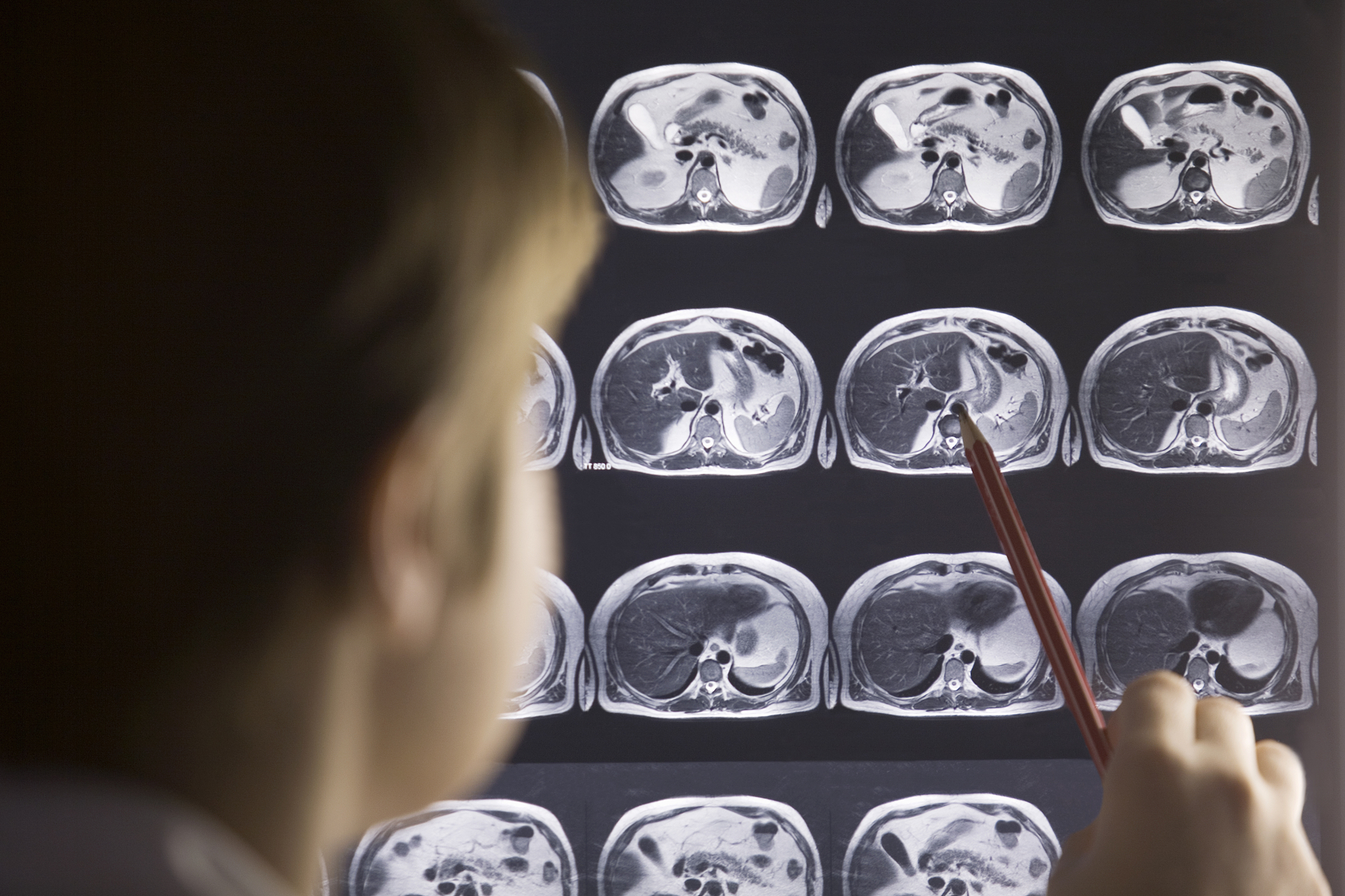 超声造影：更精准显示斑块内新生血管的利器