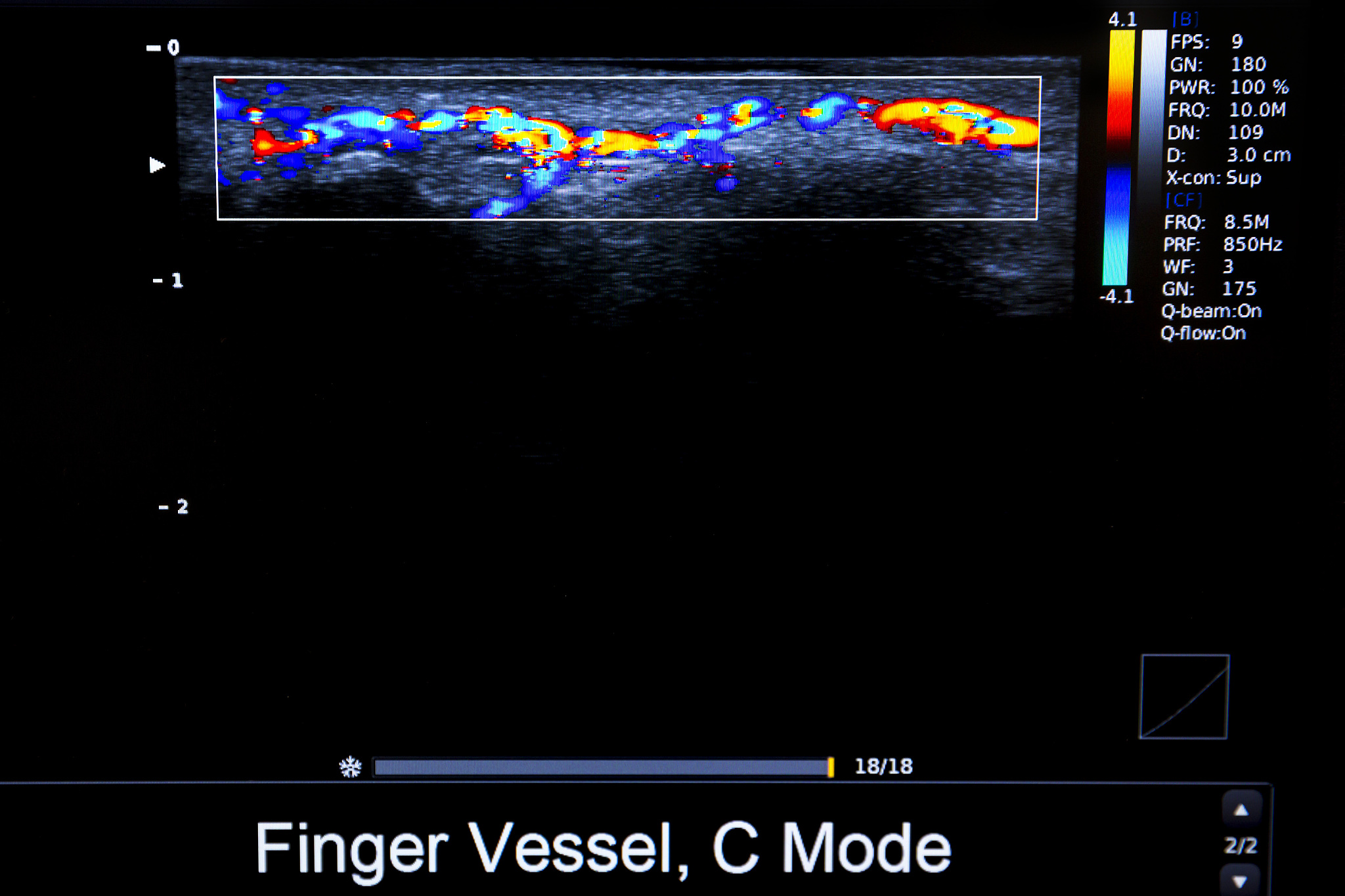 血管内超声诊断导管探头处增加显影性有什么项目必要性