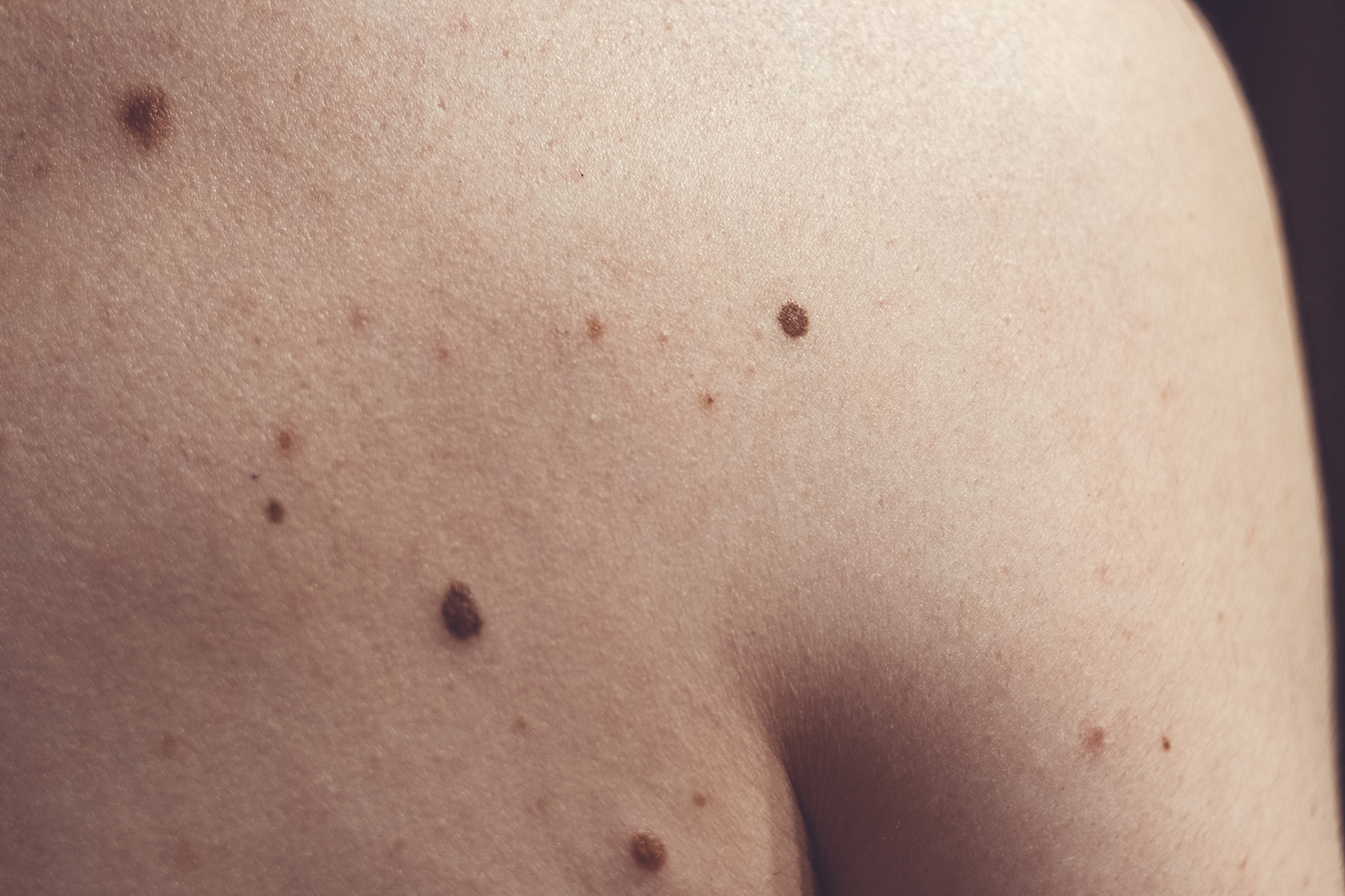 melanocytic nevus, some of them dyplastic or atypical, on a cauc