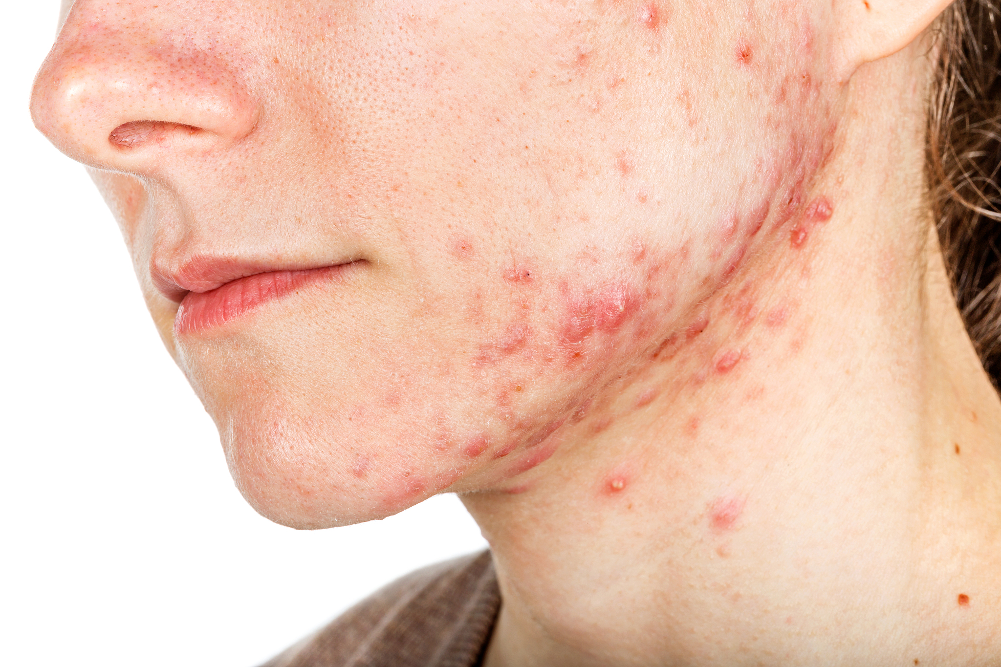 young girl with skin problem