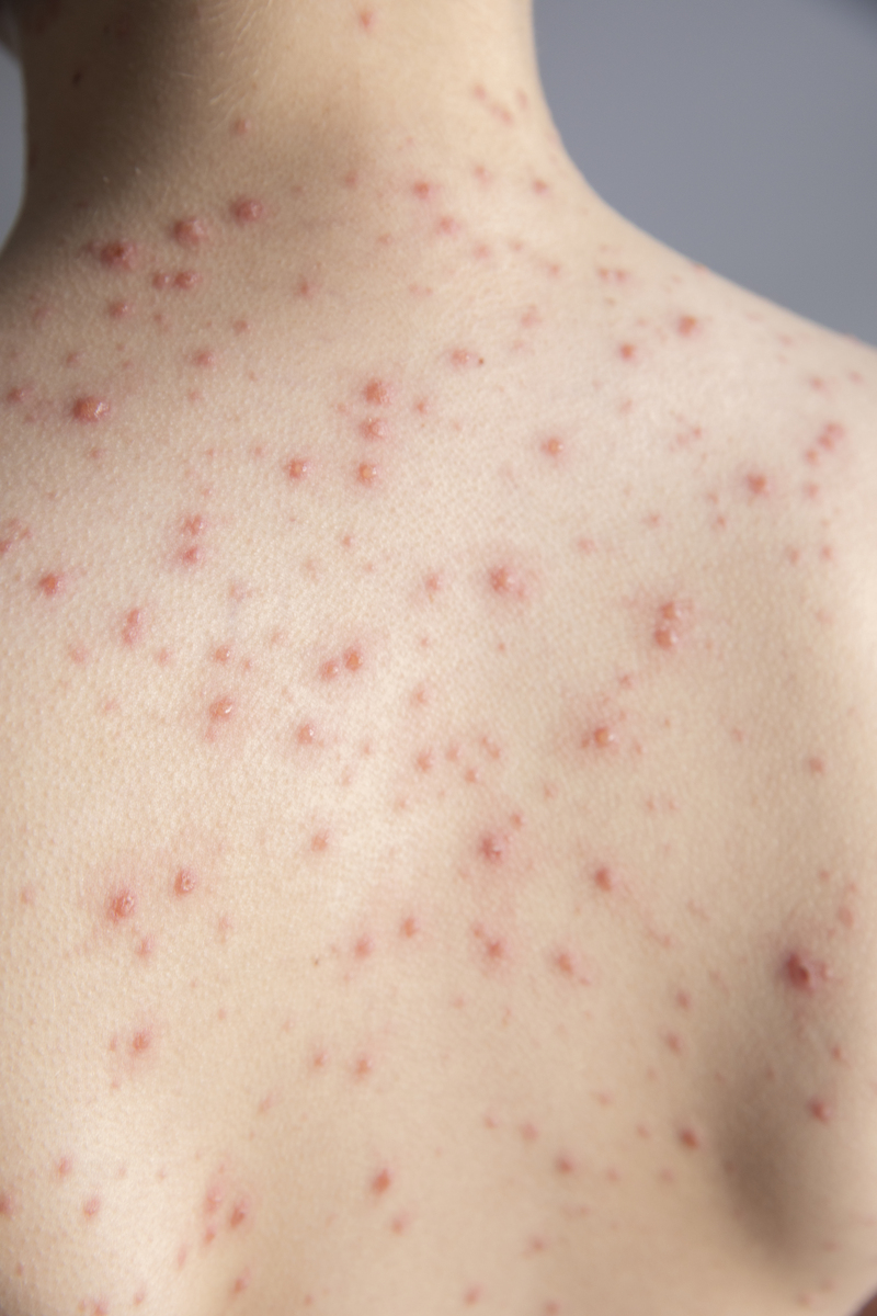 发烧后起疹子：可能是这些病毒感染！