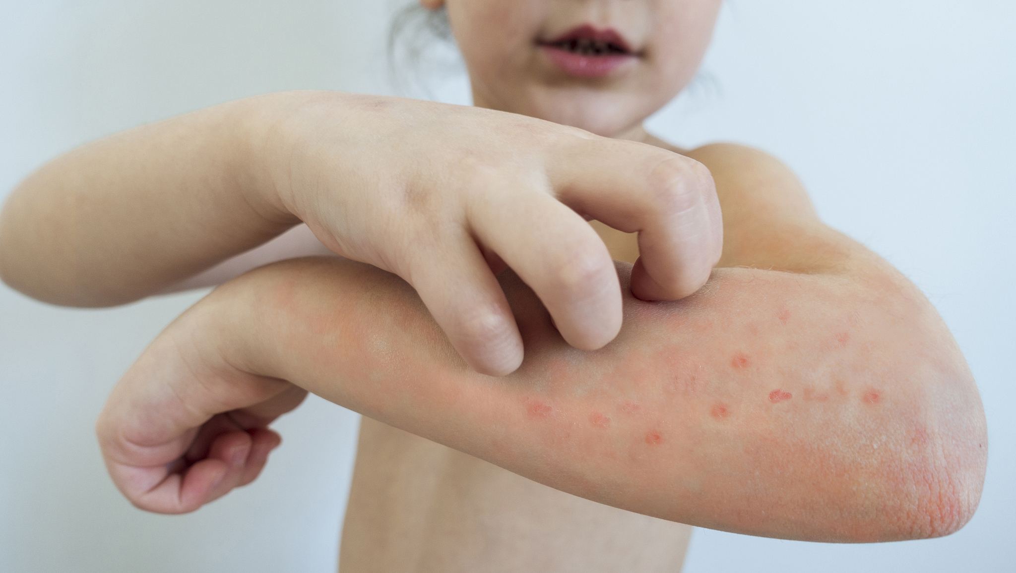 chickenpox