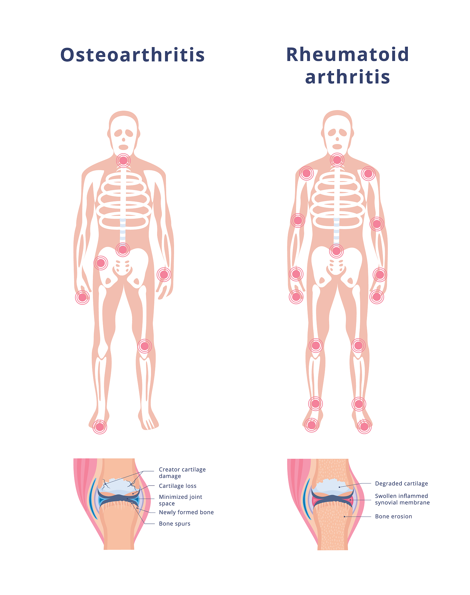 Osteoarthritis: Causes, Symptoms, Treatment & Management